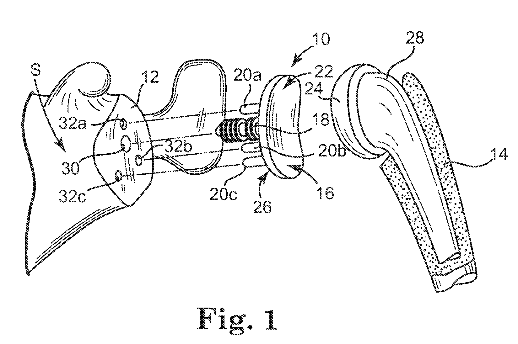 Glenoid implant anchor post