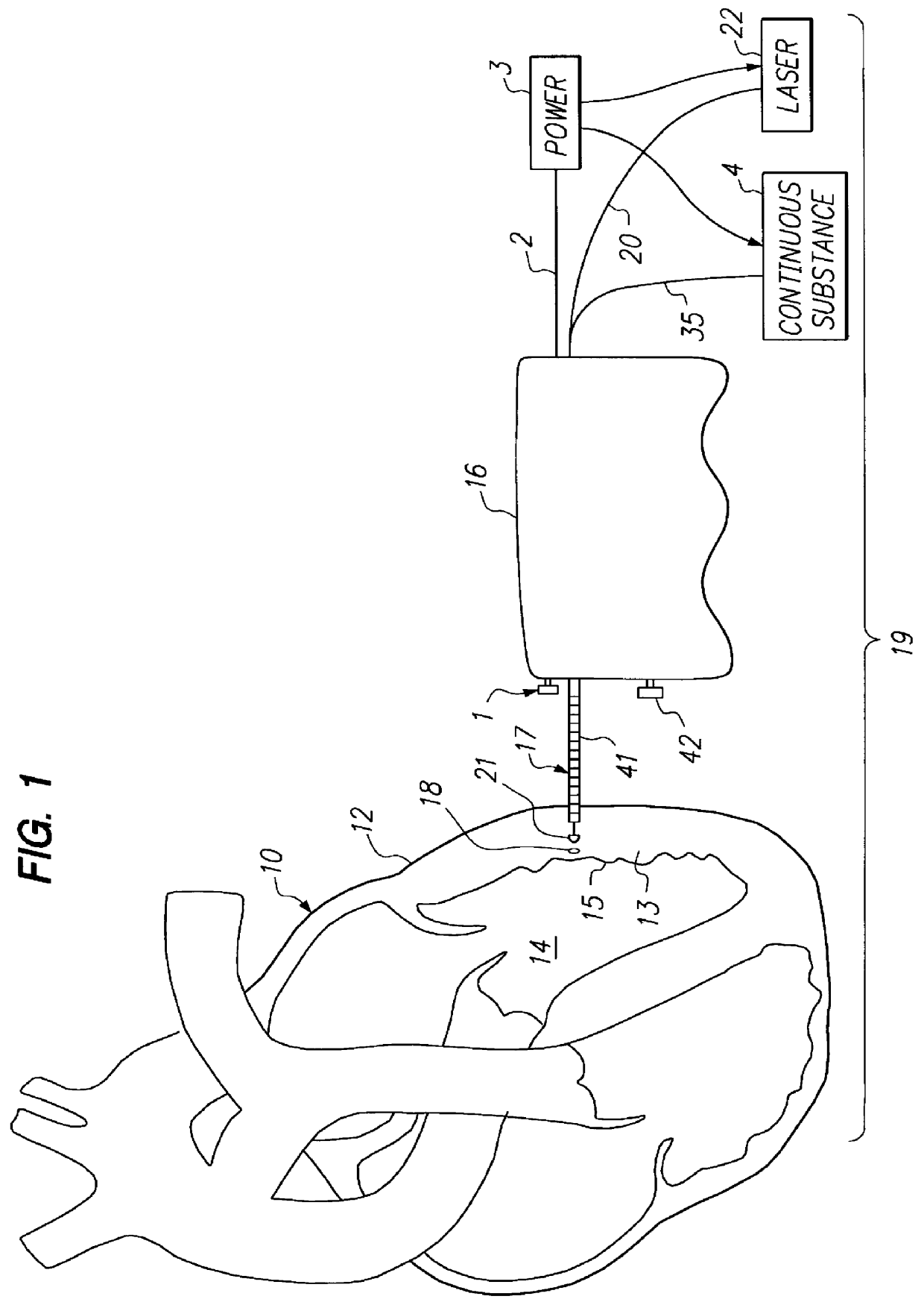 Method for creation of drug delivery and/or stimulation pockets in myocardium