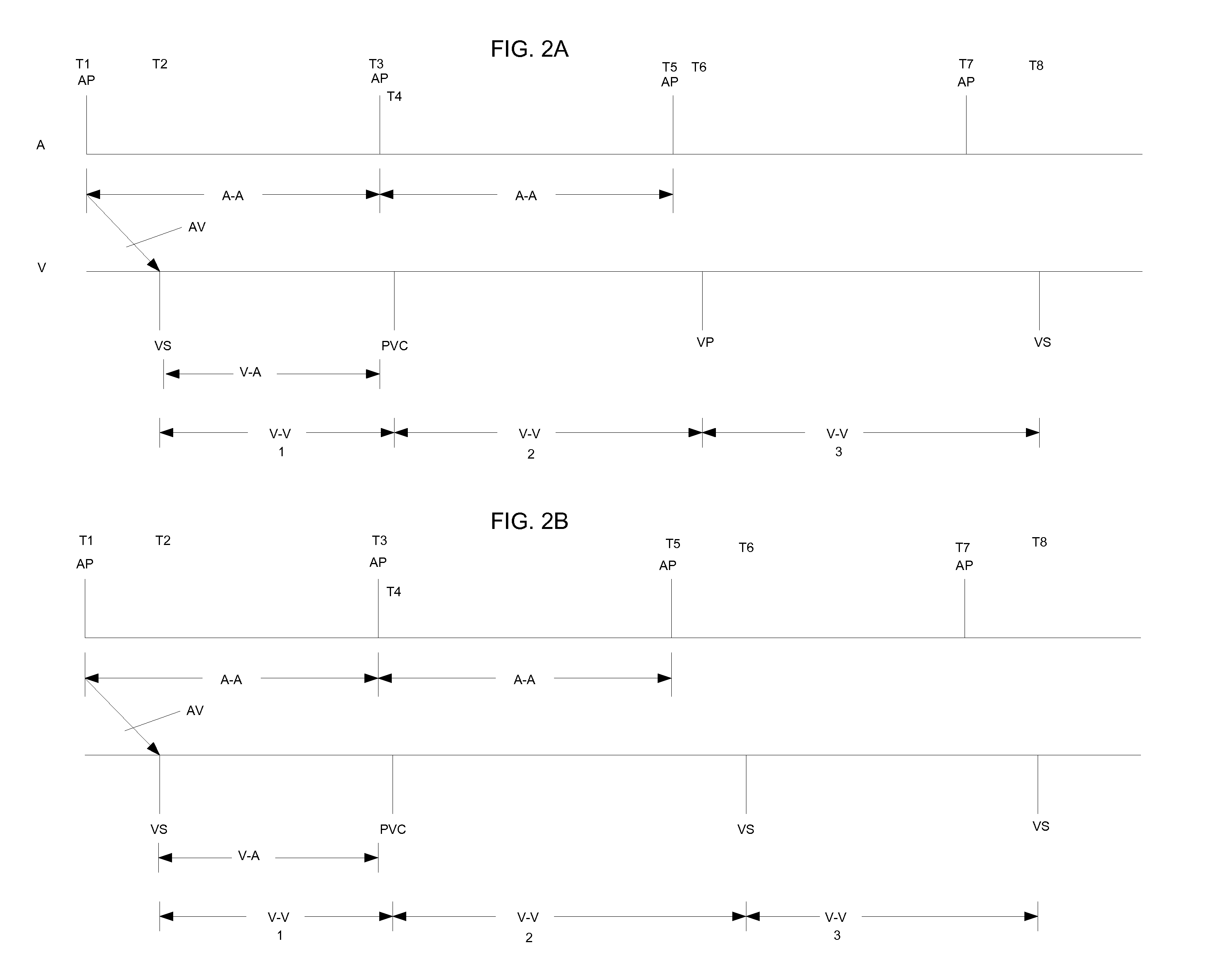 System and Method for Promoting Instrinsic Conduction Through Atrial Timing Modification and Calculation of Timing Parameters