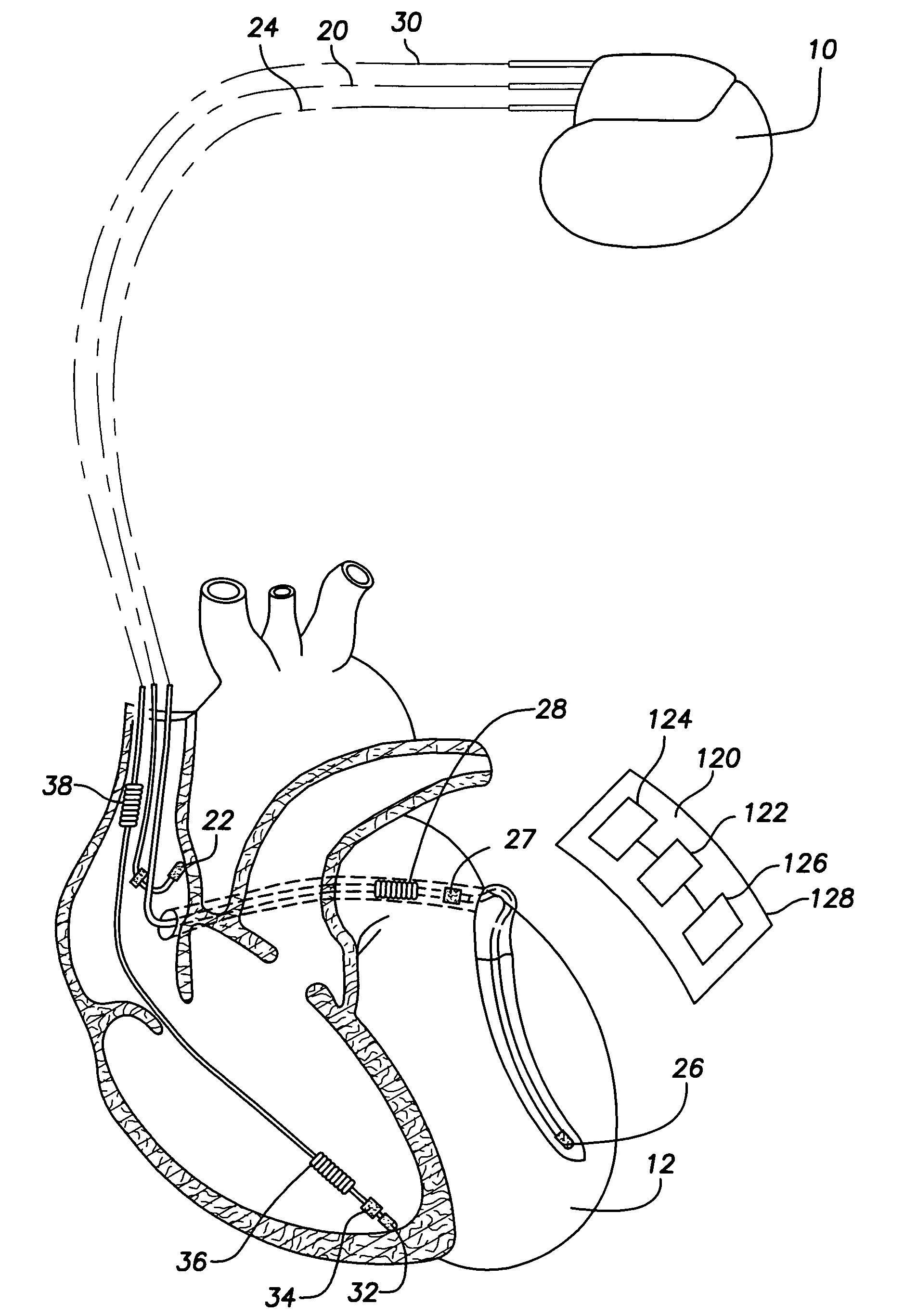 Subcutaneous cardiac stimulation device providing anti-tachycardia pacing therapy and method