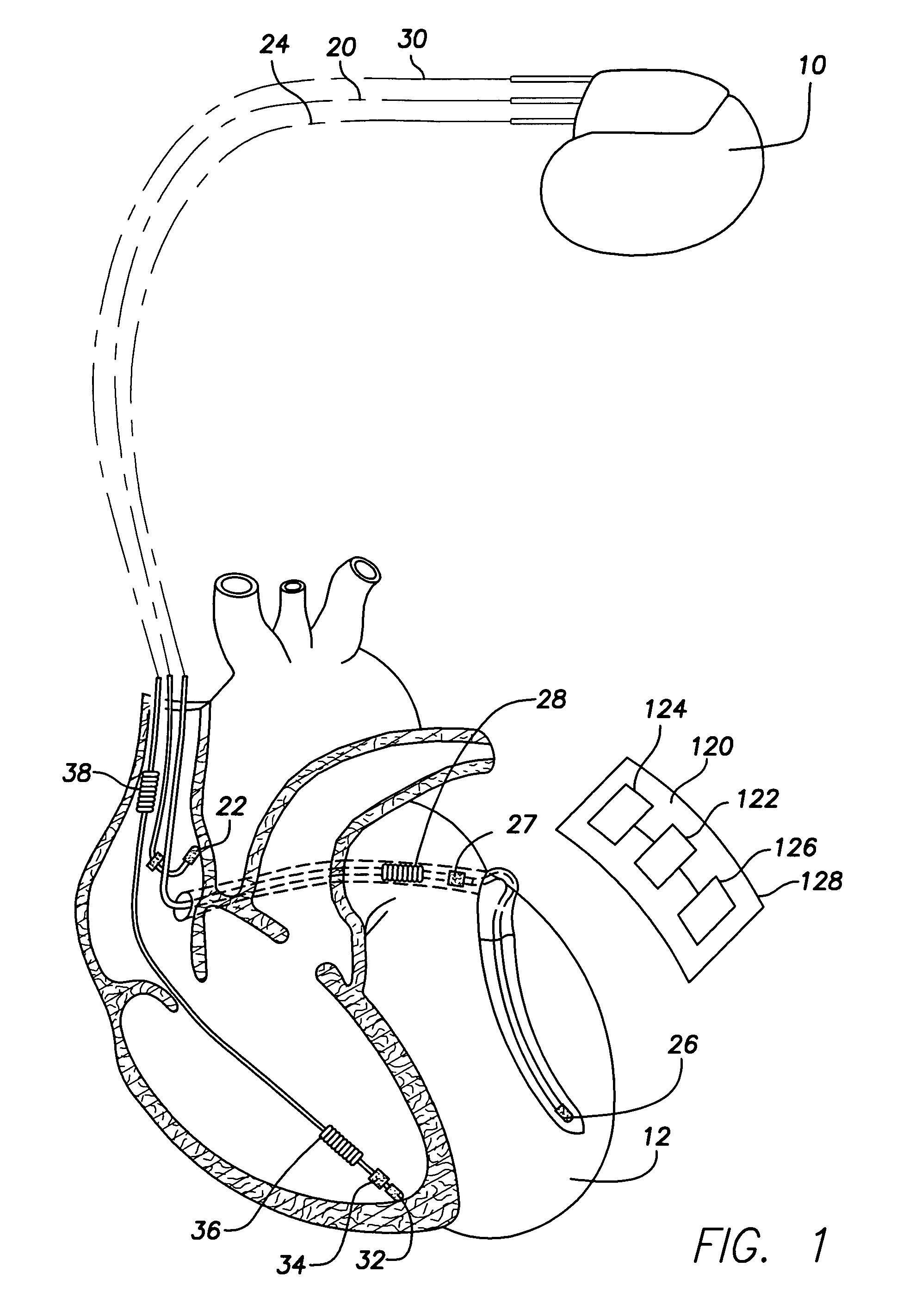 Subcutaneous cardiac stimulation device providing anti-tachycardia pacing therapy and method