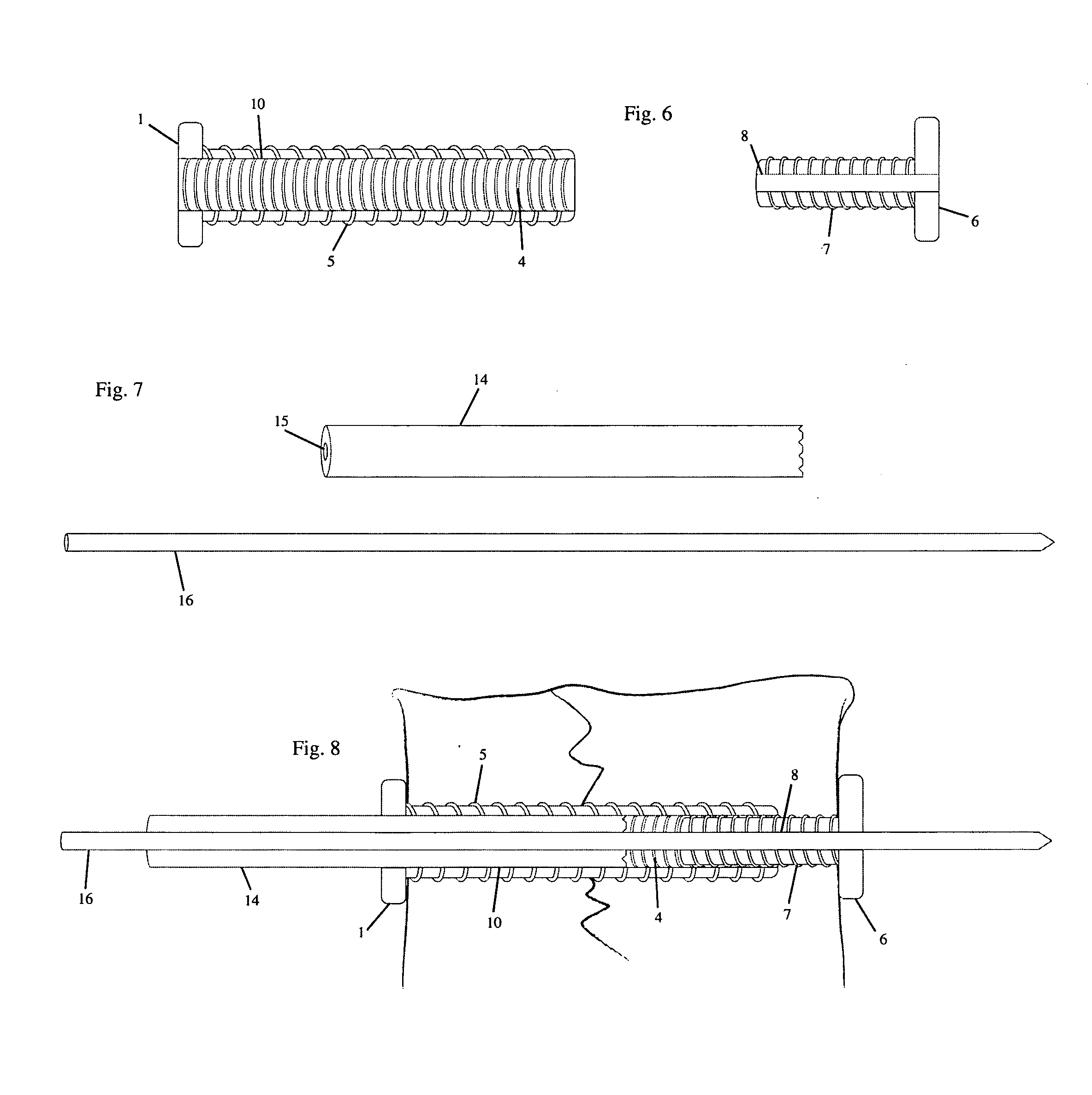 Connecting Cannulated Bone Screws