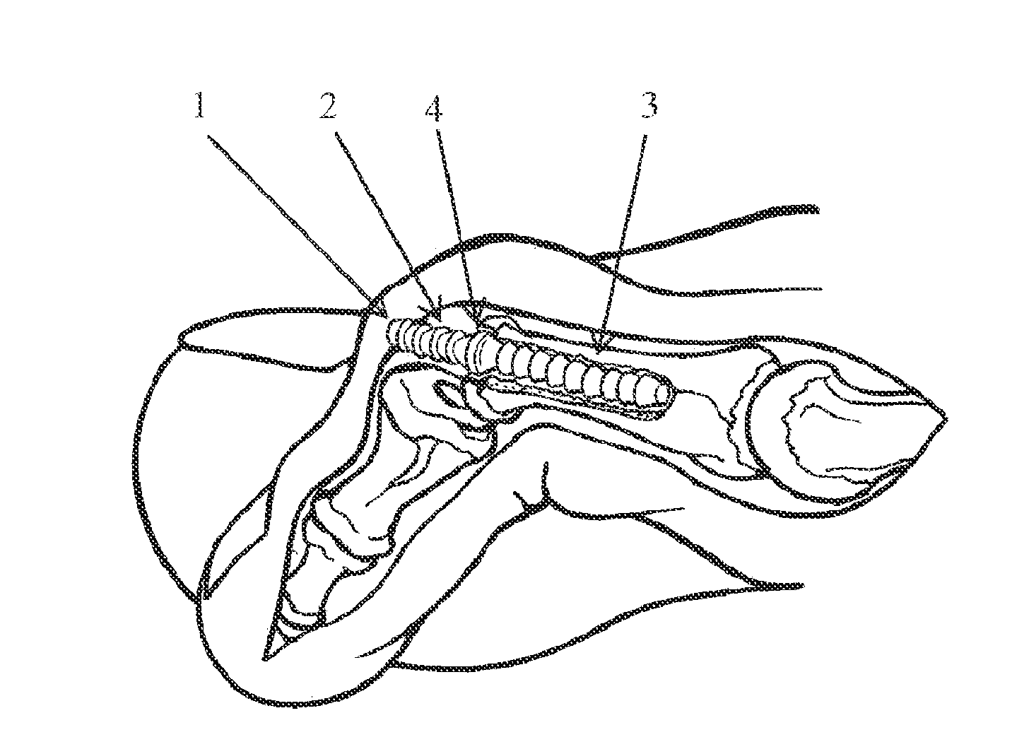 Cortical Bone Pin