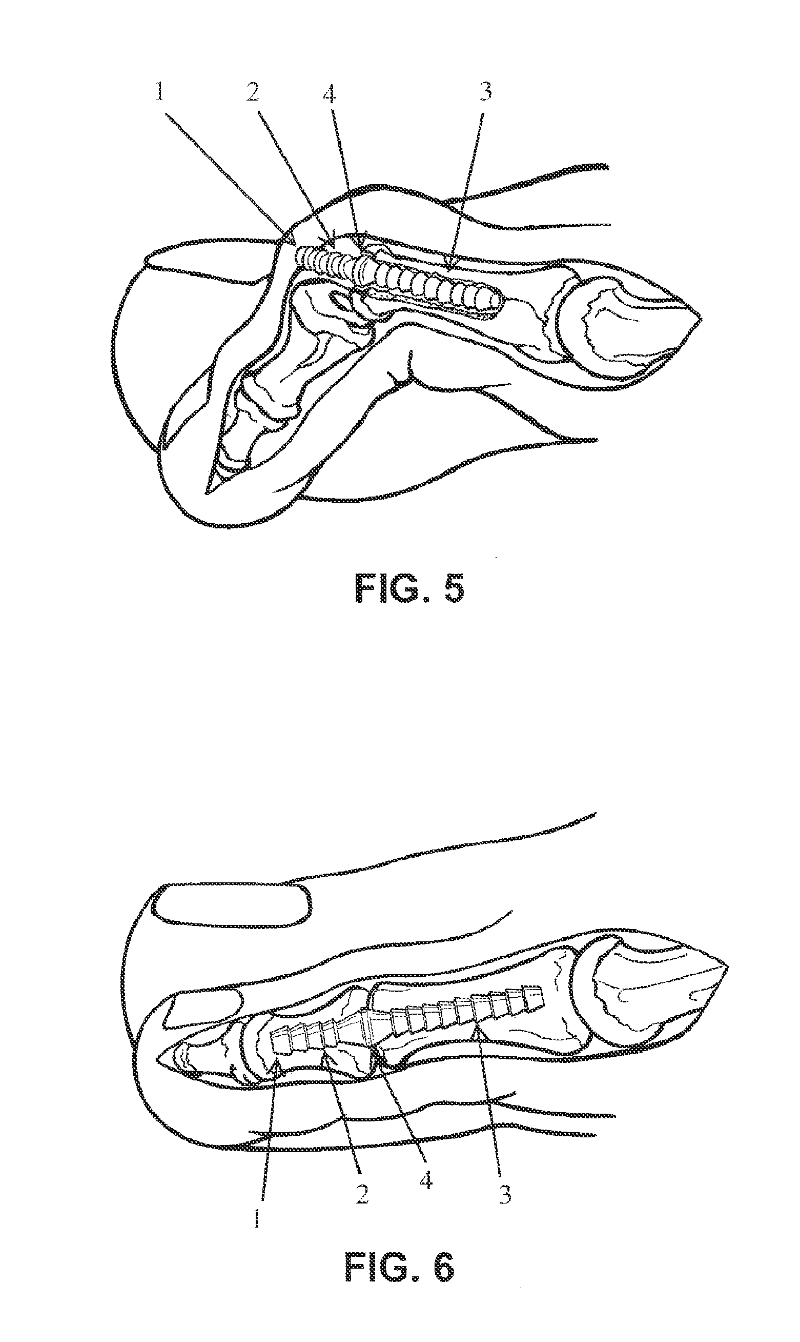 Cortical Bone Pin