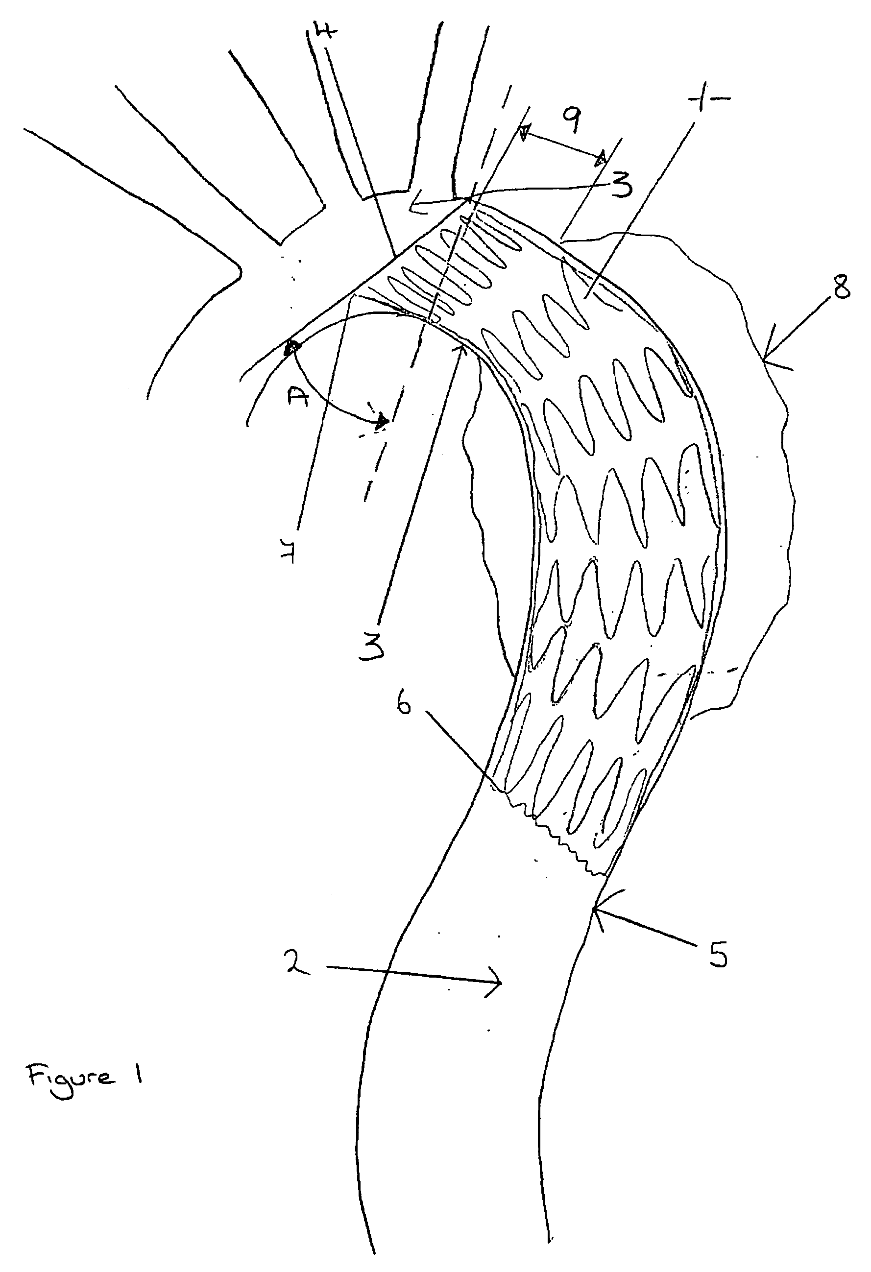 Curvable stent-graft and apparatus and fitting method