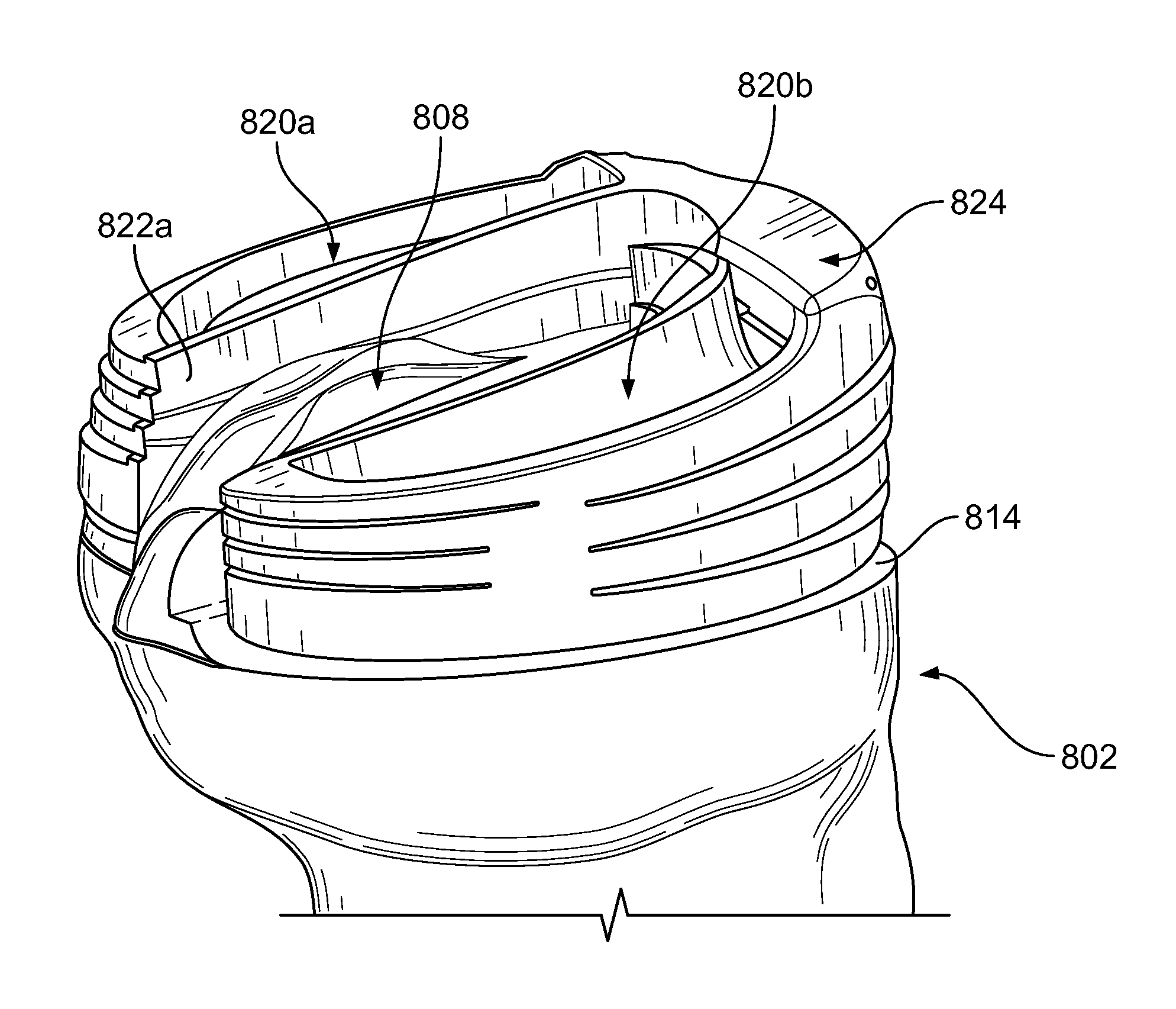 Morphologically curved sagittal wall of a tibial implant