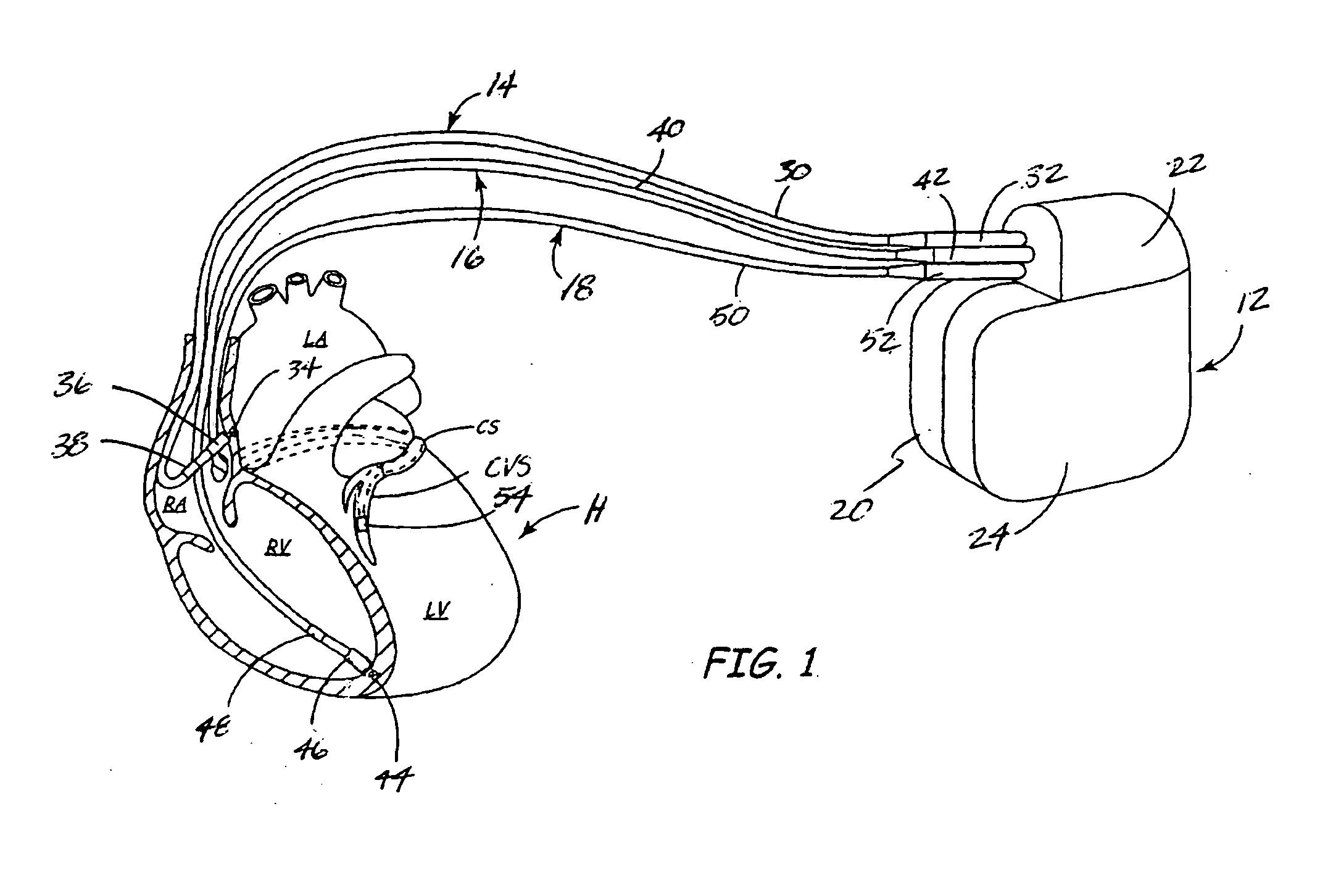 Method and apparatus for detecting left ventricular lead displacement based upon EGM change