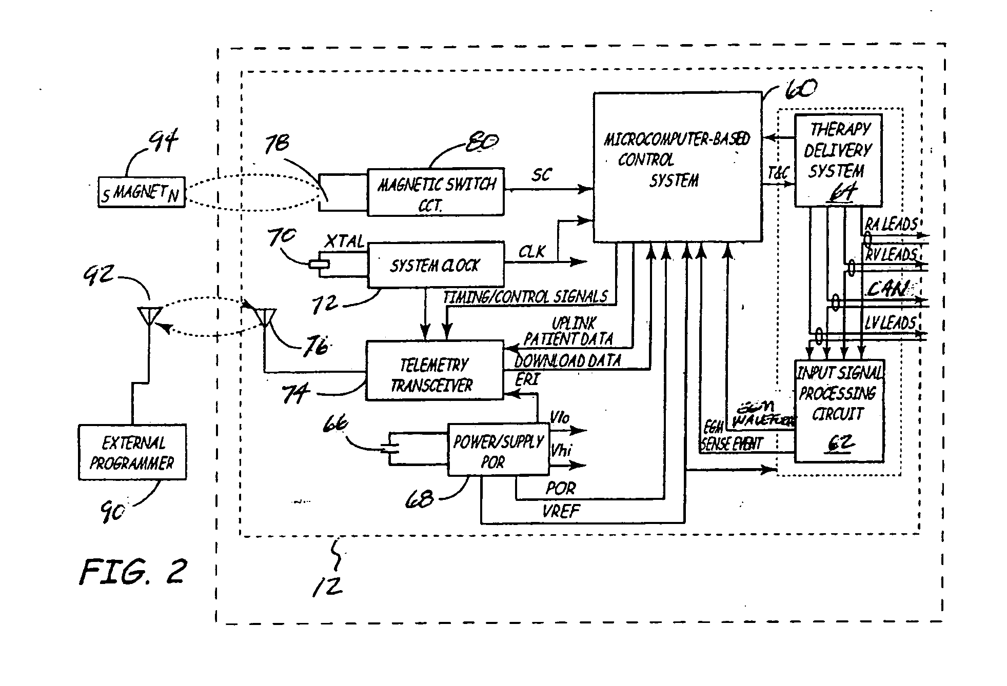 Method and apparatus for detecting left ventricular lead displacement based upon EGM change