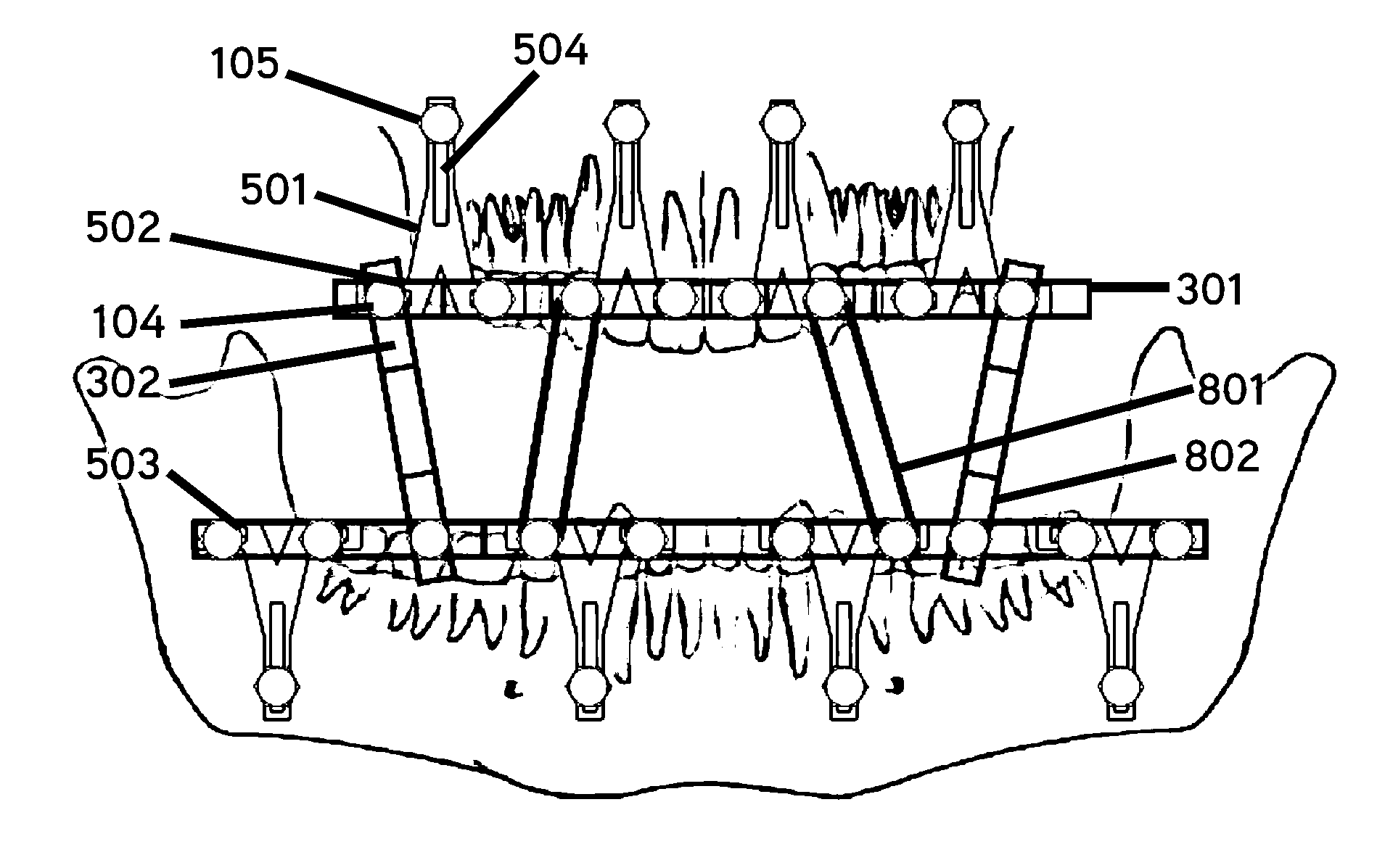 Bone Fixation System And Methods