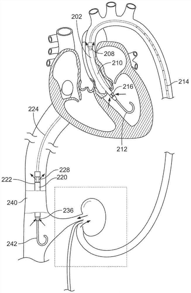 Use of cardiac assist device to improve kidney function