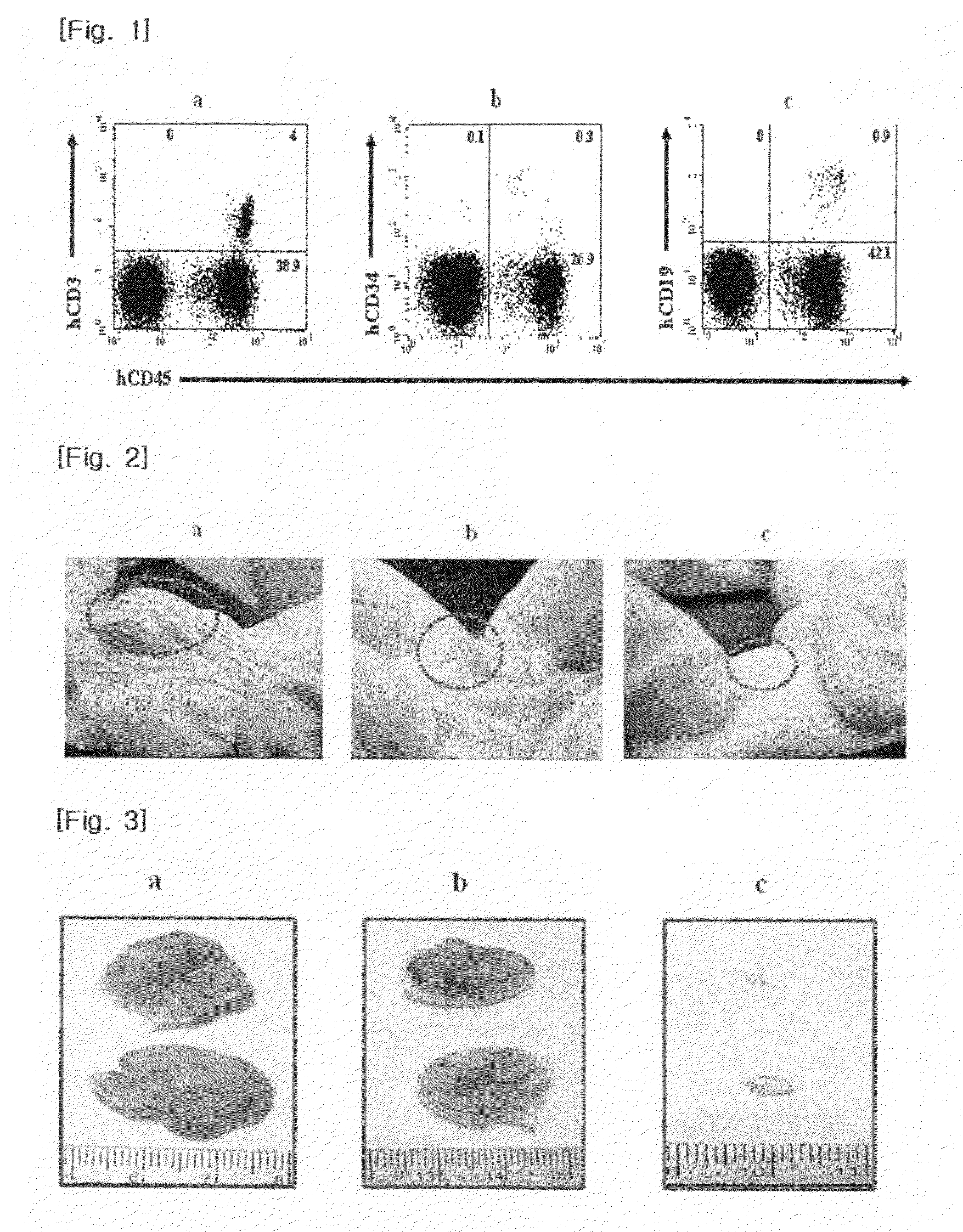 Composition for in vivo transplantation for treatment of human cervical cancer comprising mononuclear cells derived from umbilical cord blood