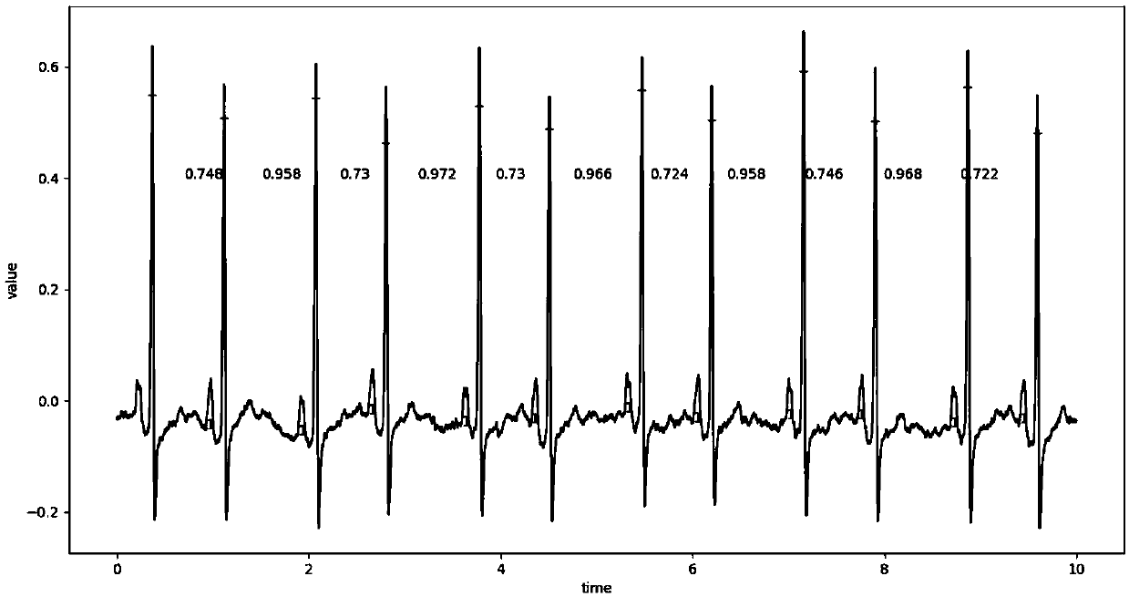 Atrial-fibrillationartificial intelligenceidentification method and device containing heterotopicheartbeat judgment