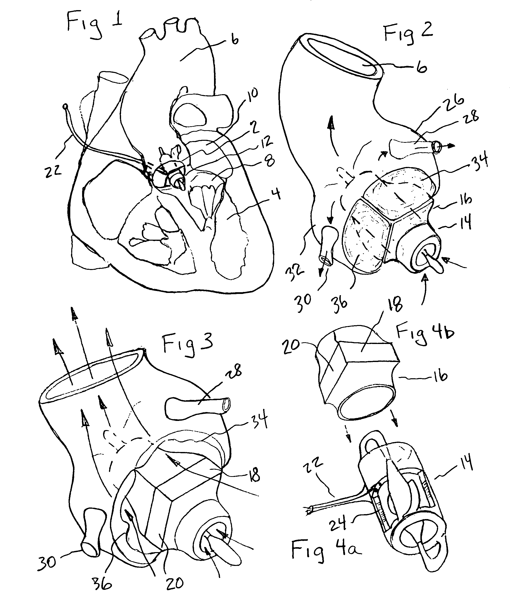 Minimally invasive transvalvular ventricular assist device