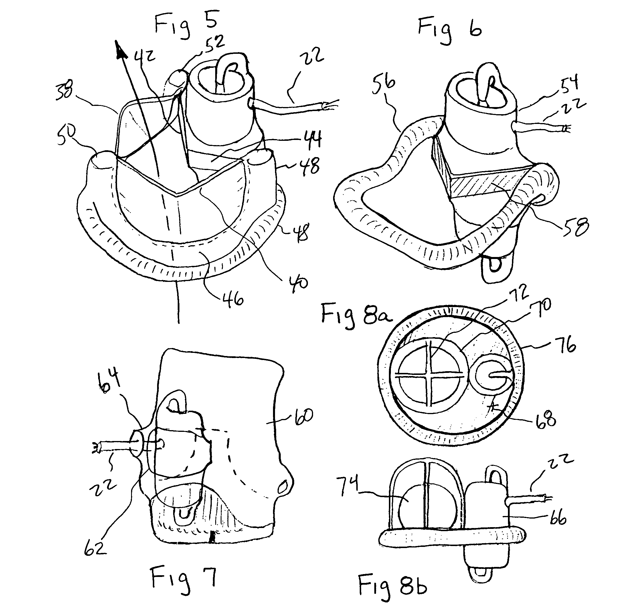 Minimally invasive transvalvular ventricular assist device