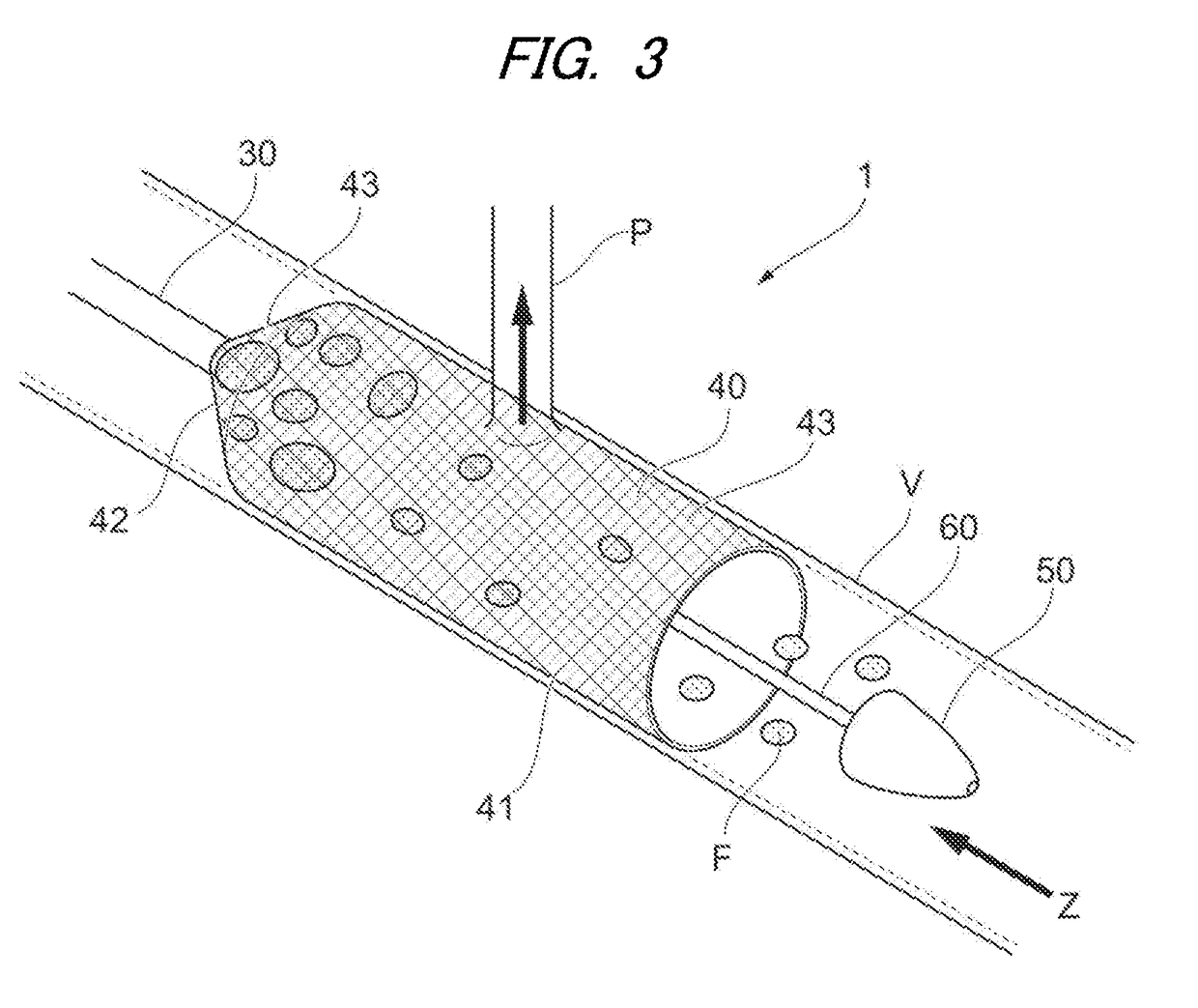 Infarction prevention device and treatment method