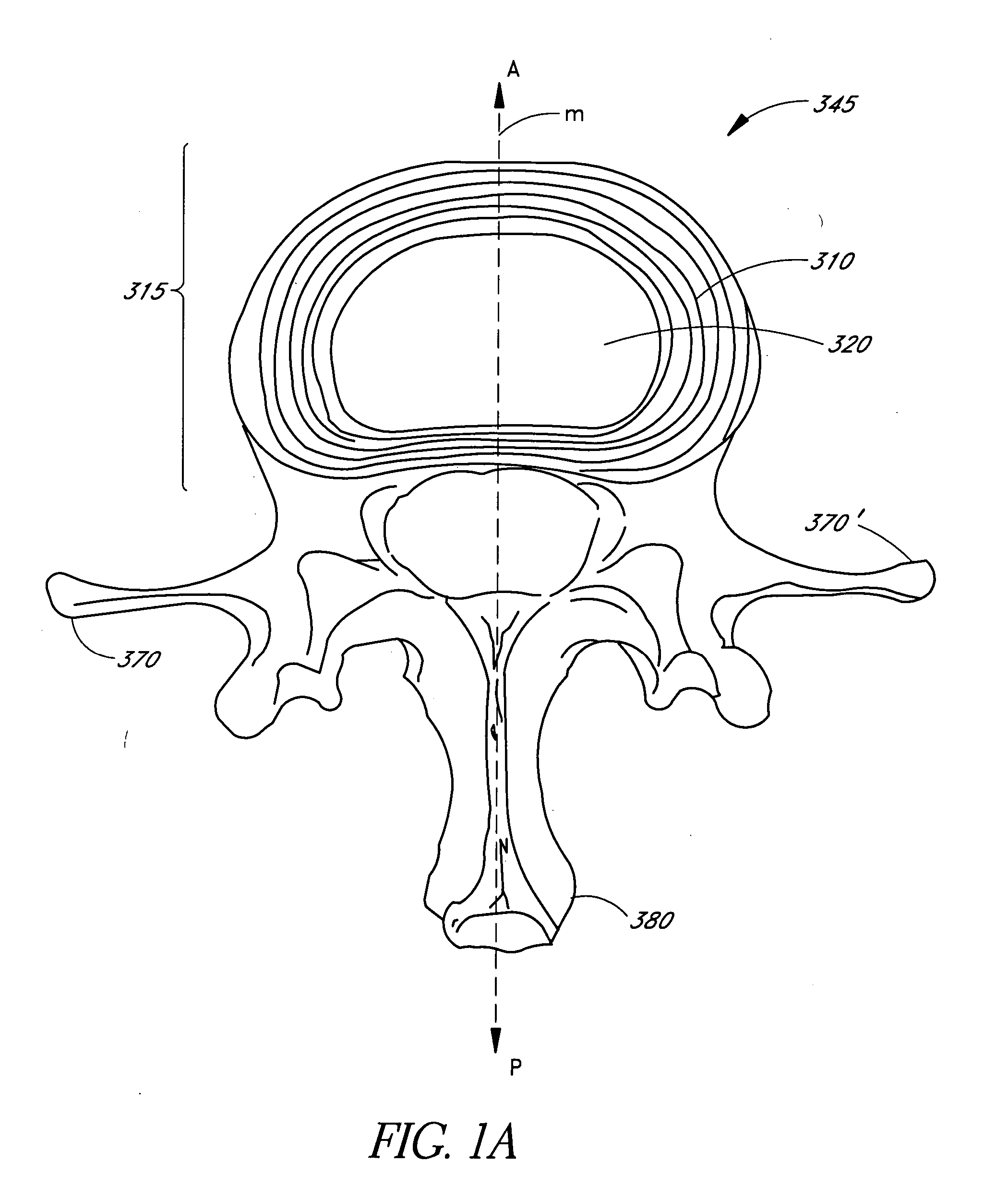 Minimally invasive method for delivery and positioning of intervertebral disc implants