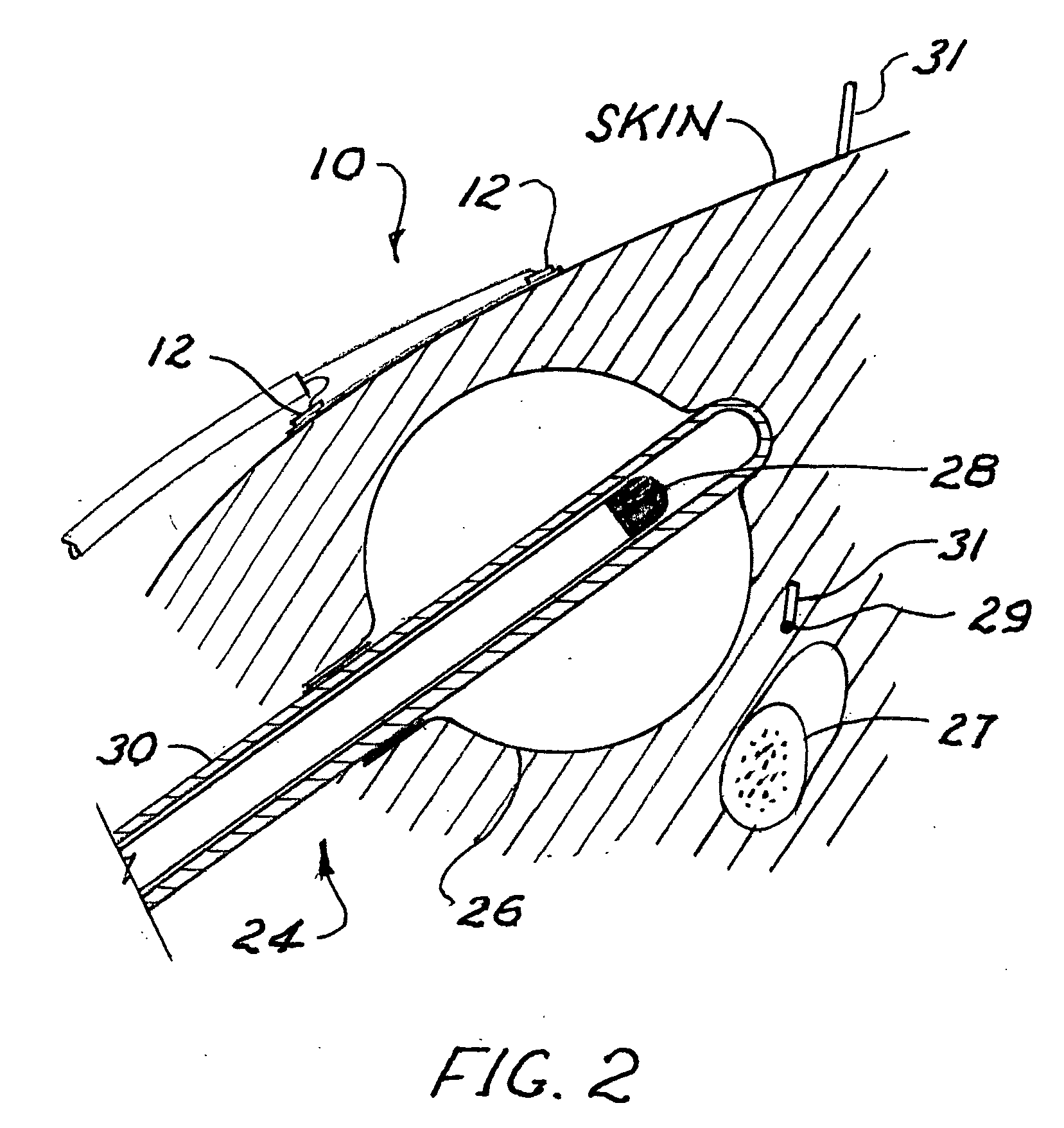 Radiation sensor arrays for use with brachytherapy