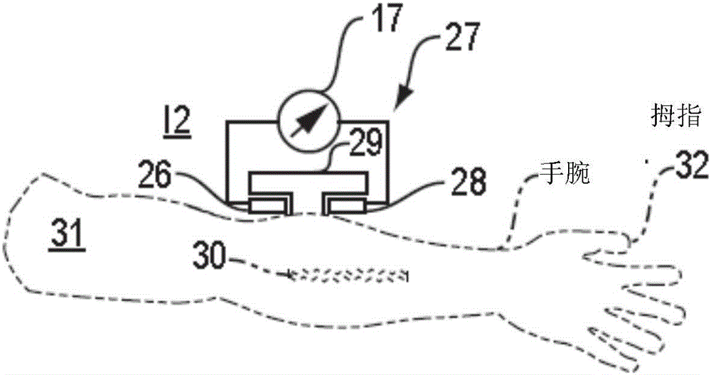 Trans-spinal direct current modulation systems