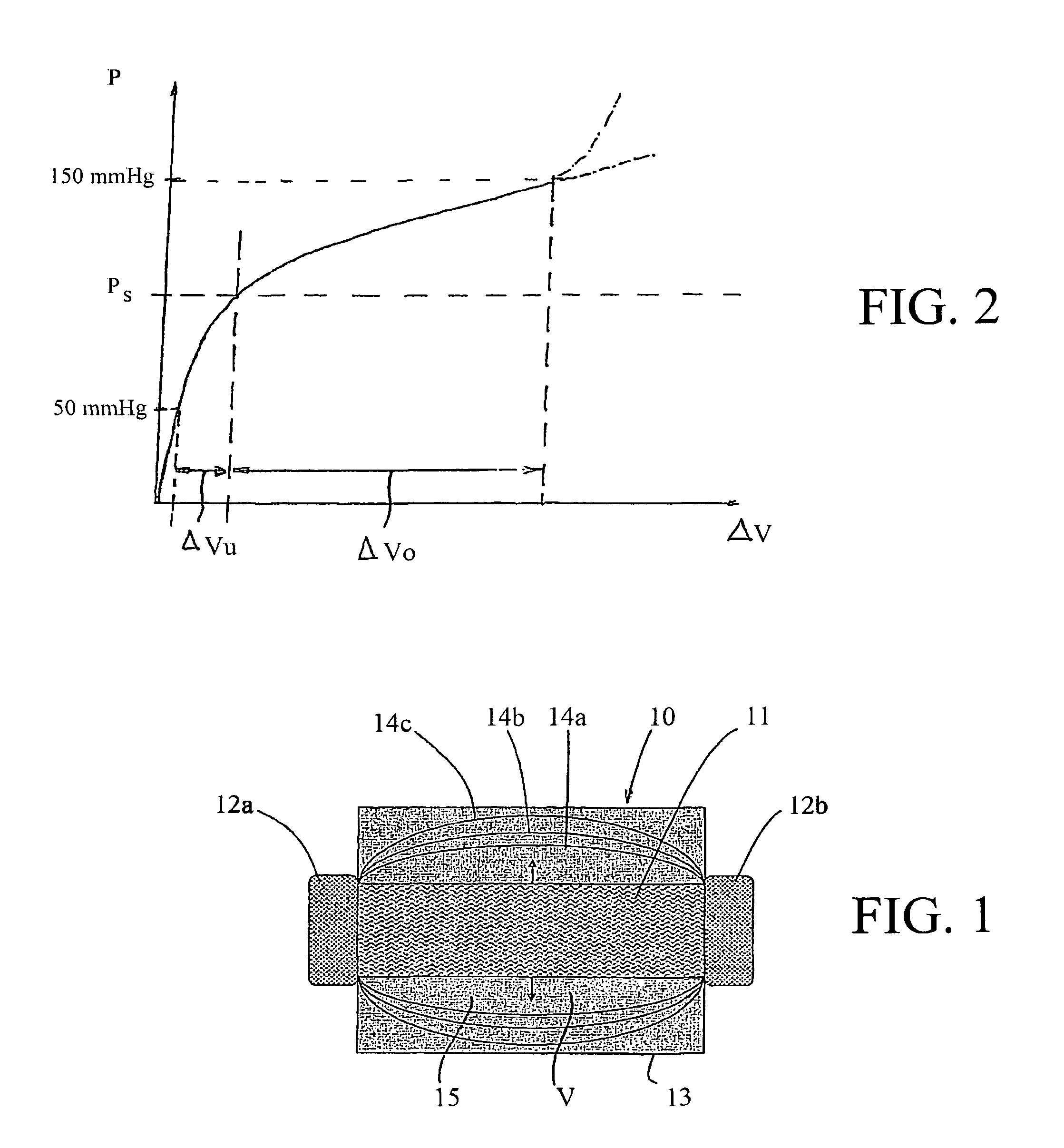 Bypass device for influencing blood pressure