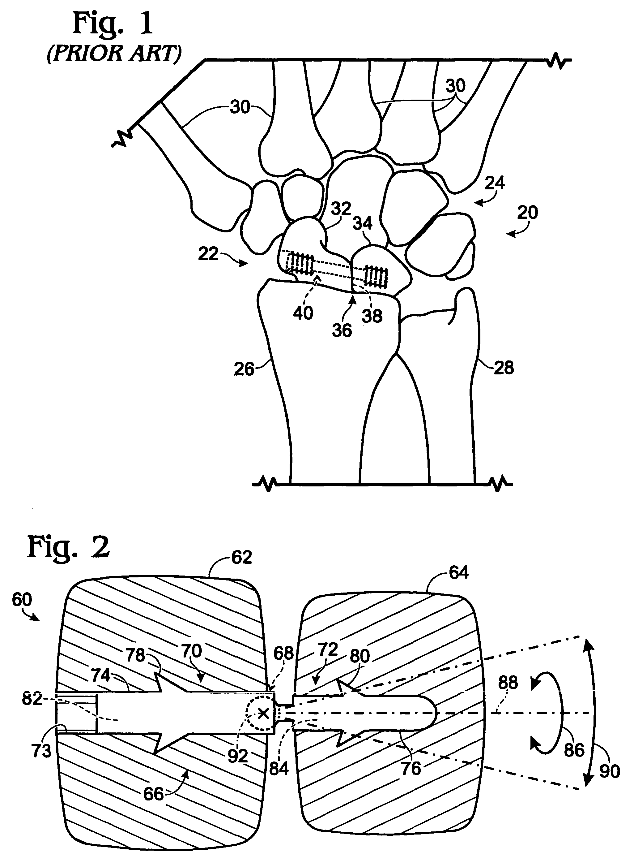 Bone connector with pivotable joint