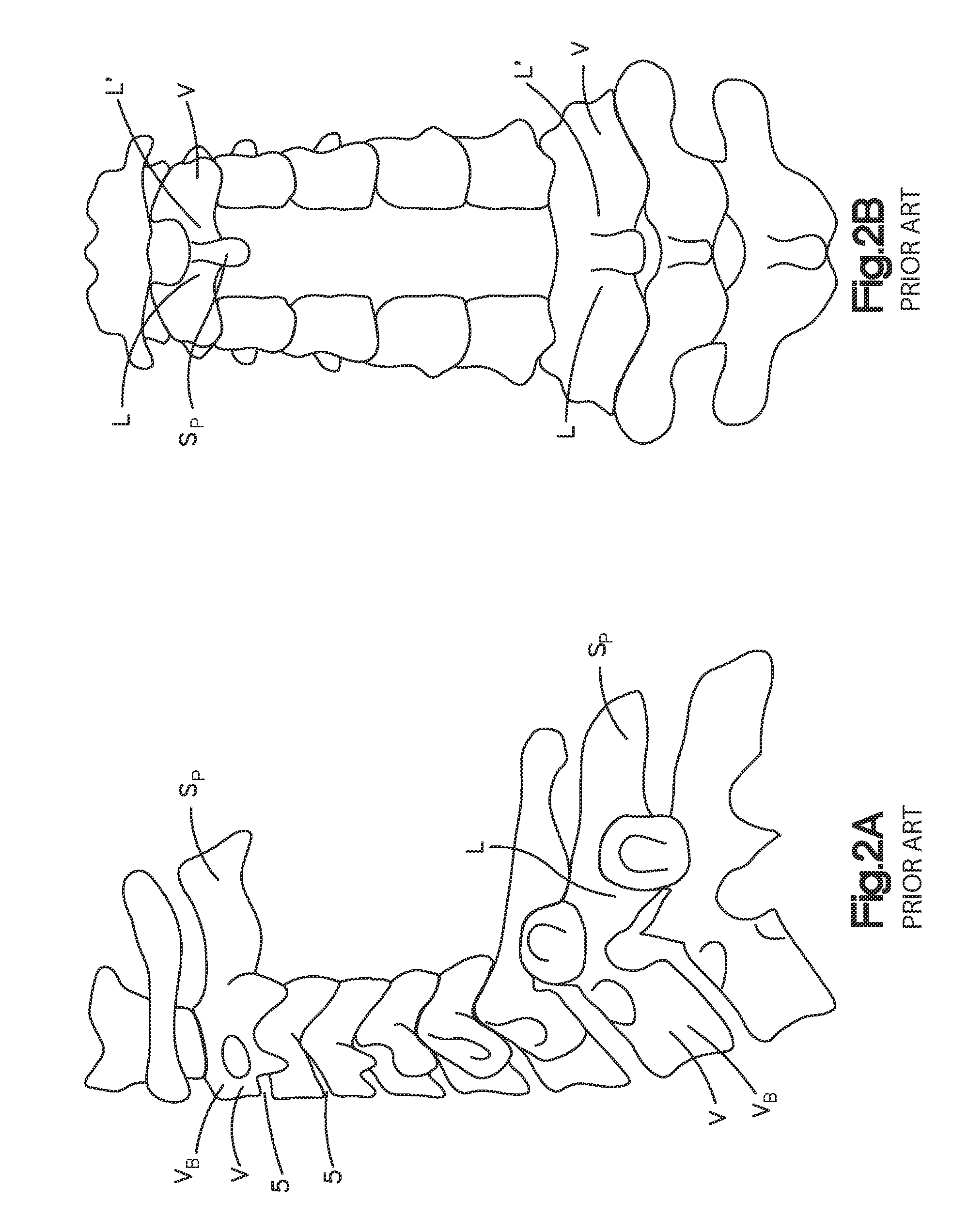 Spine stabilization system and method