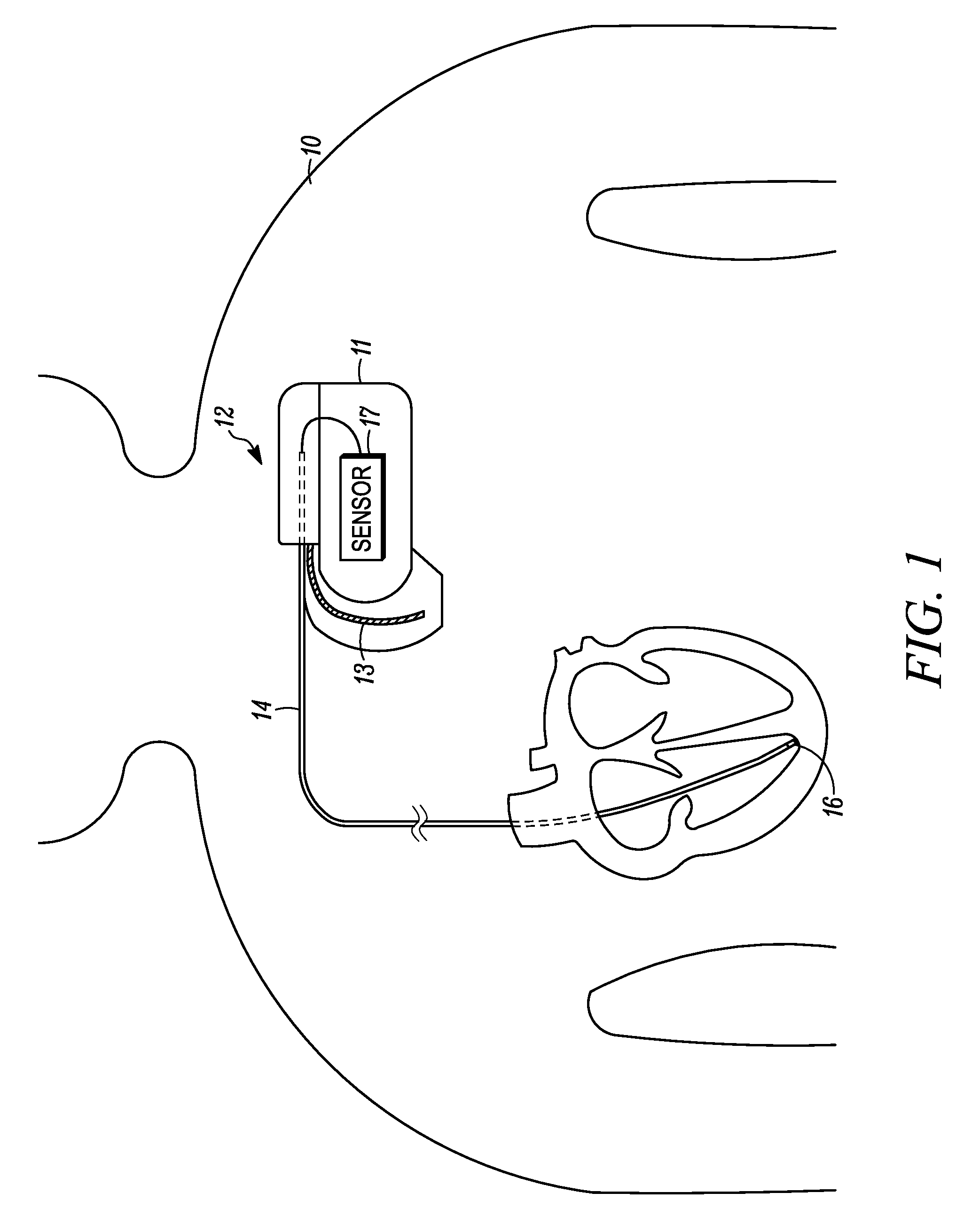 Implantable medical device with antenna