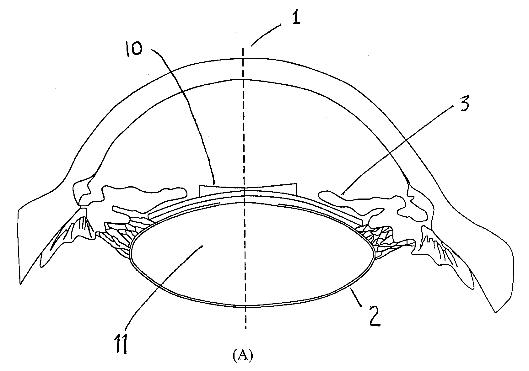 Accommodative intraocular lens system