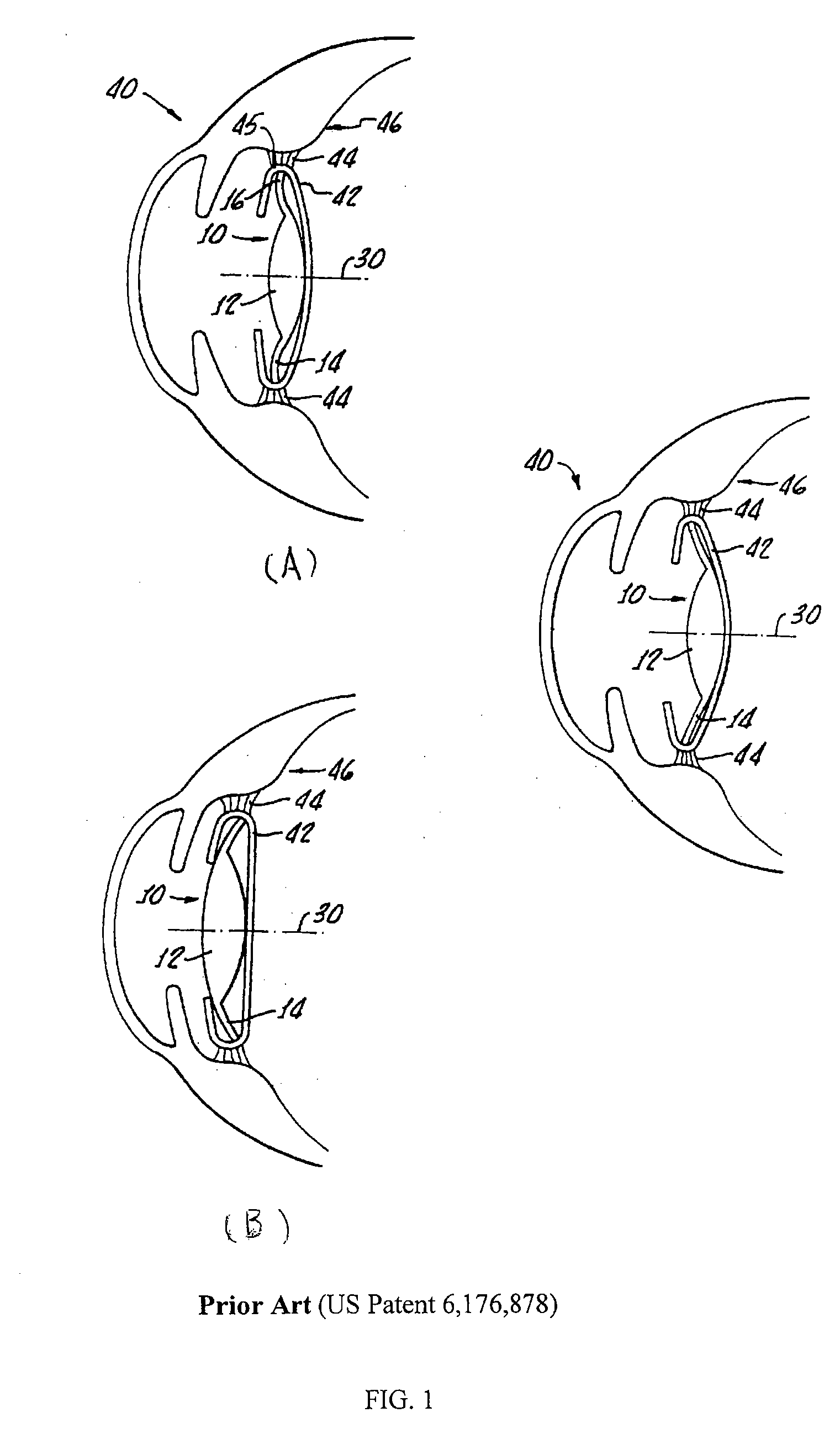 Accommodative intraocular lens system