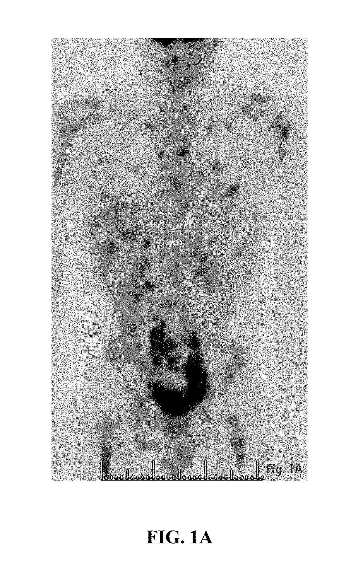 Methods of treating a neuroendocrine tumor