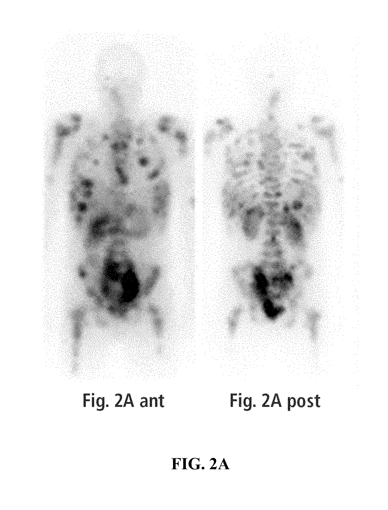 Methods of treating a neuroendocrine tumor