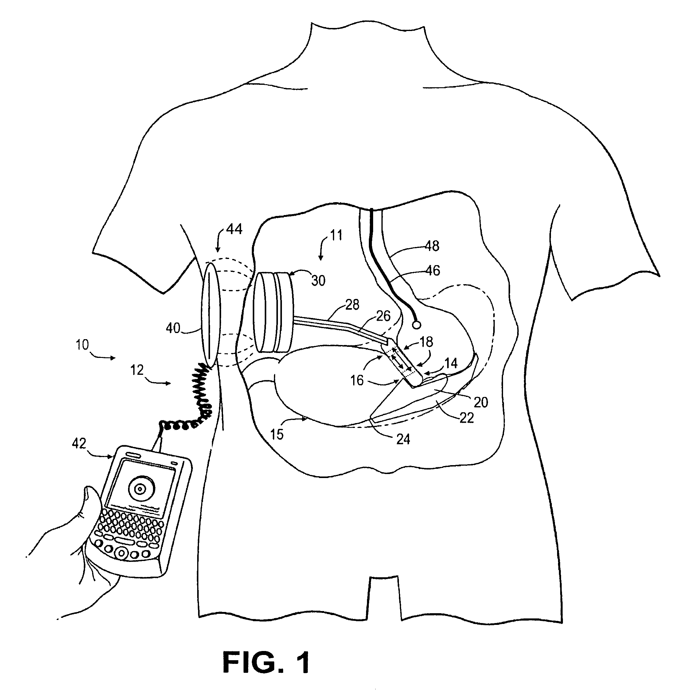 Magnetic resonance imaging (MRI) safe remotely adjustable artifical sphincter