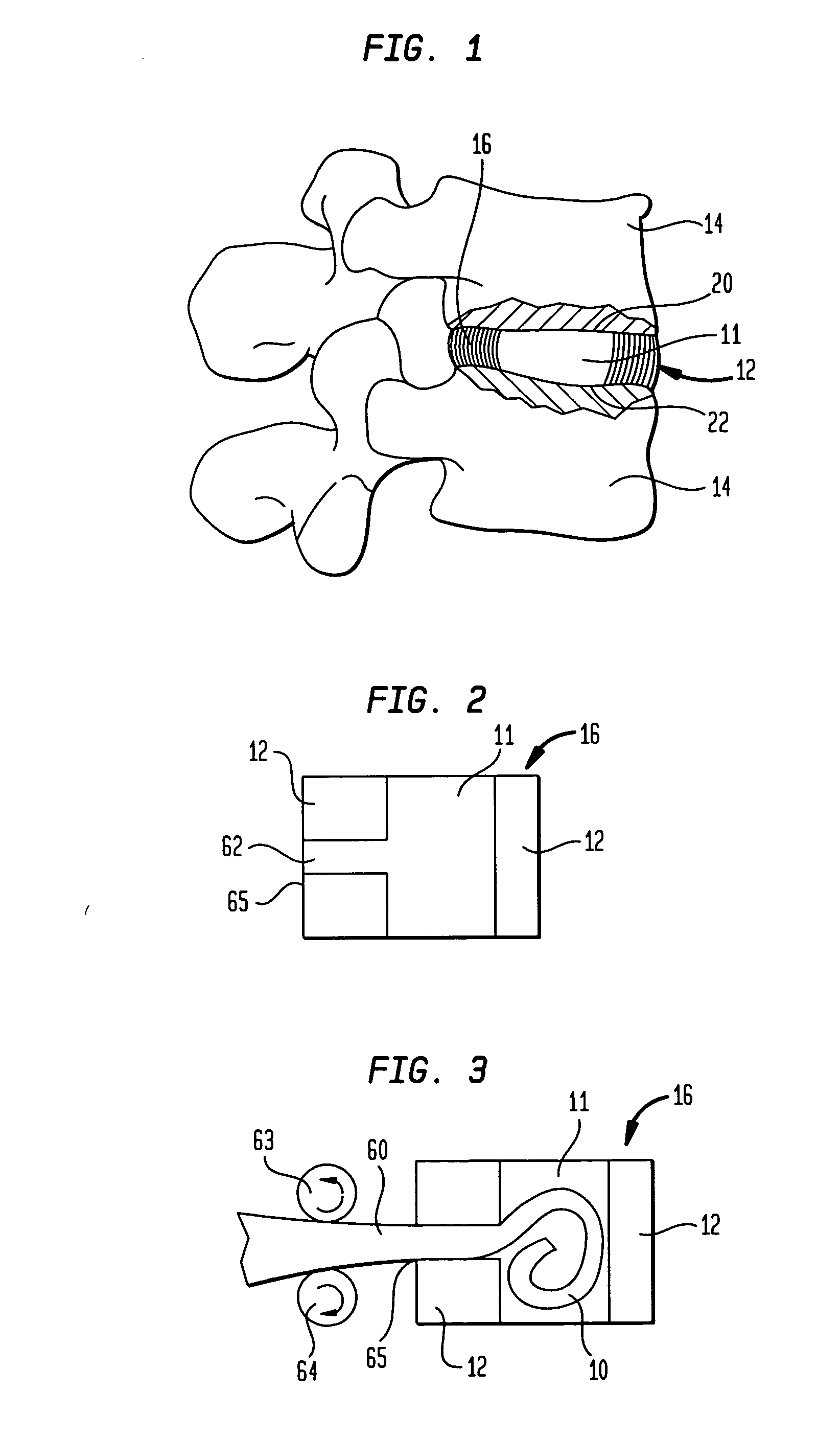 Radiovisible hydrogel intervertebral disc nucleus