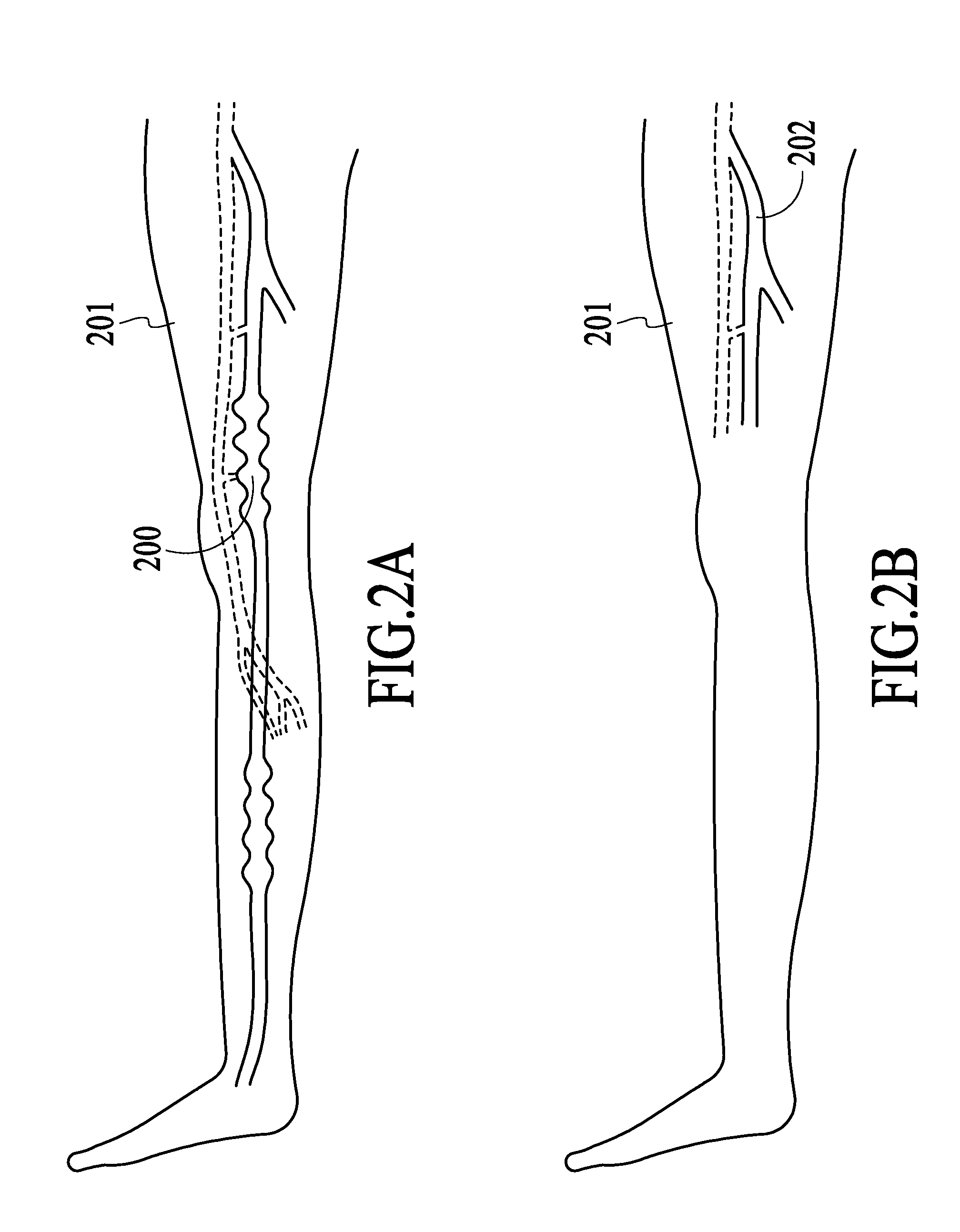 Endovenous Laser Treatment Generating Reduced Blood Coagulation