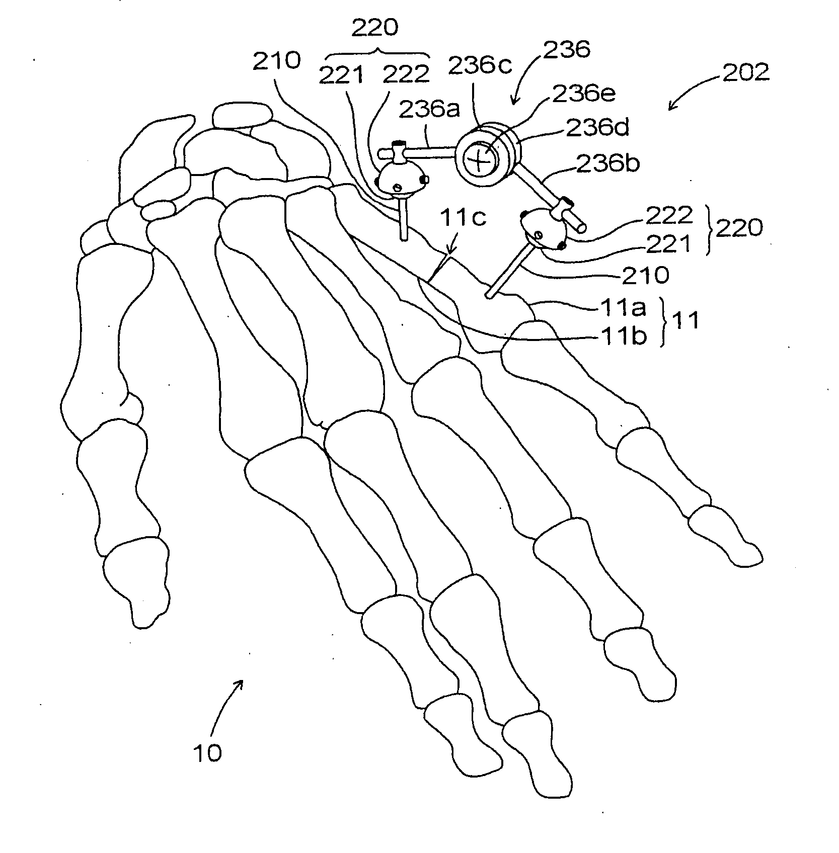 External fixator