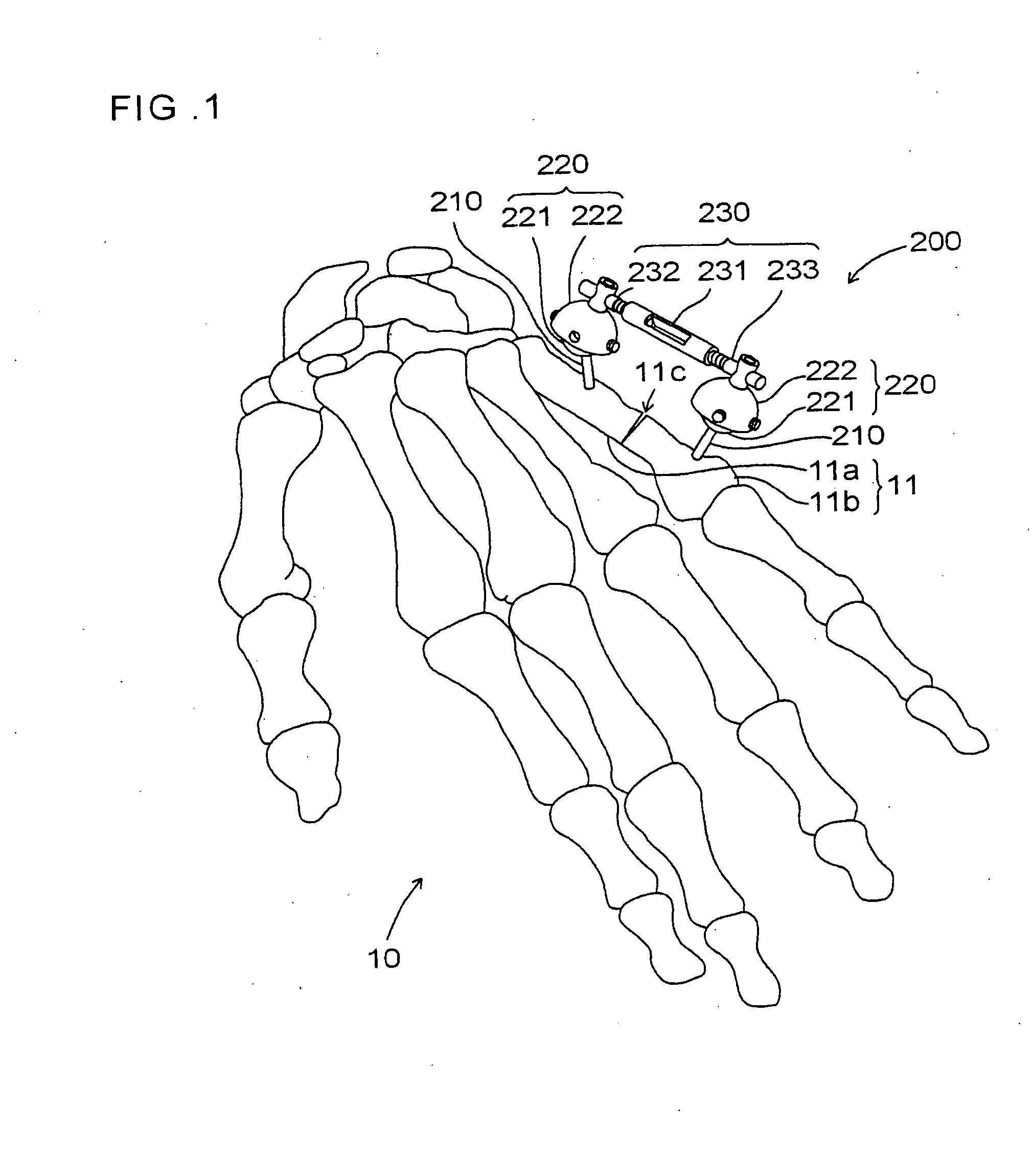 External fixator