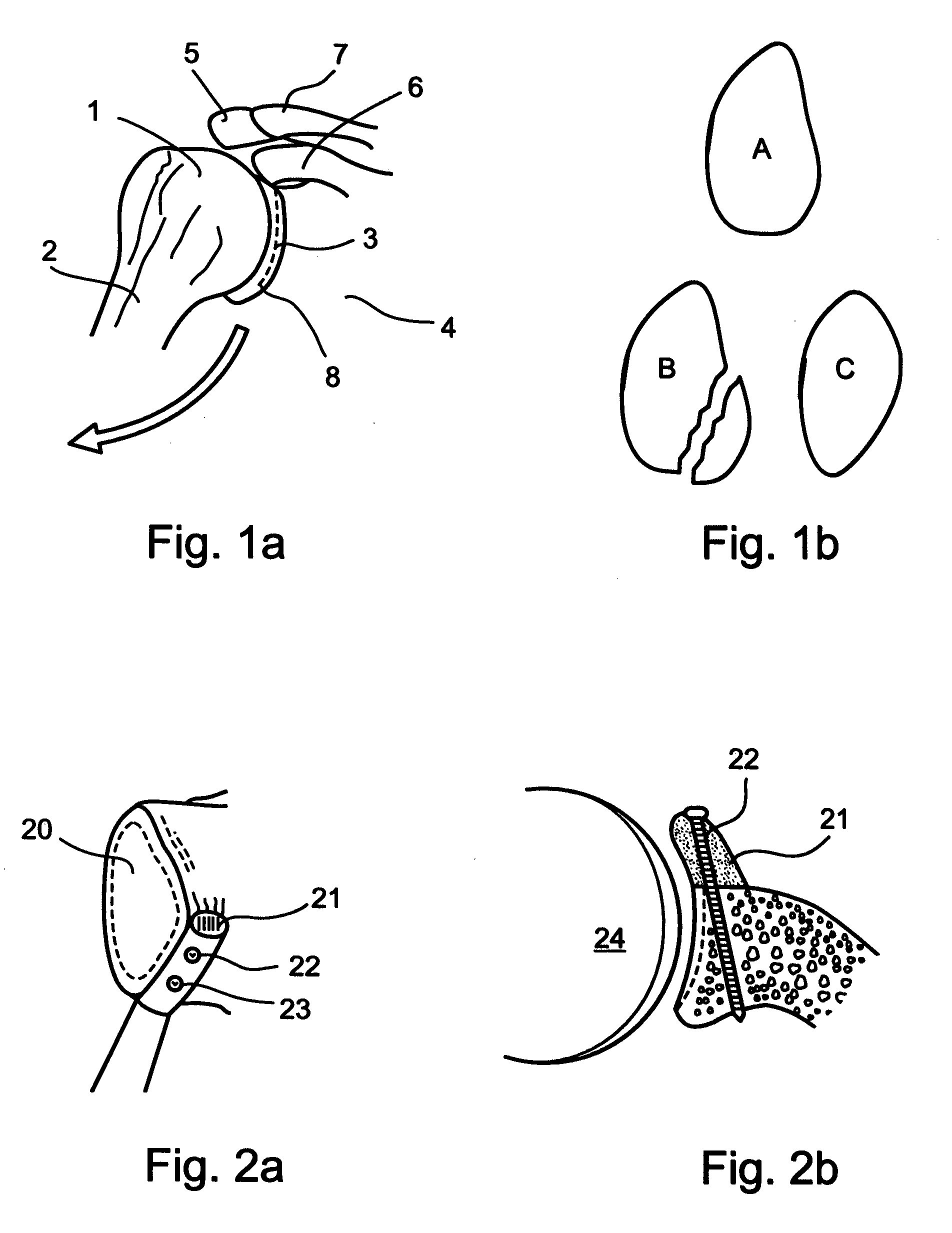 Arthroscopic bone transplanting procedure, and medical instruments useful therein