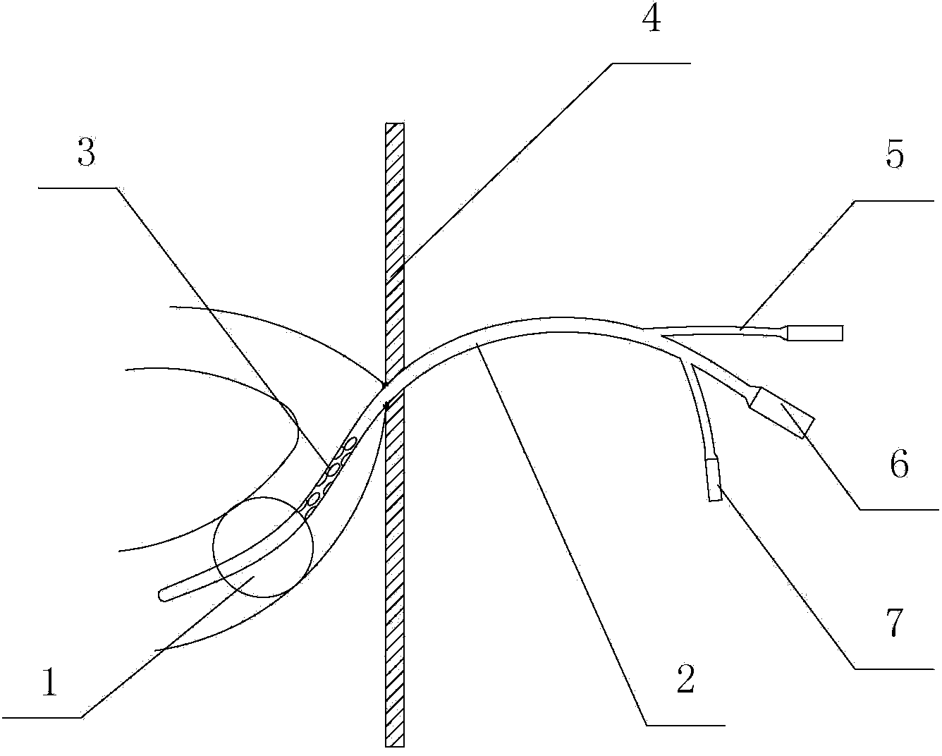 Ileum fistulization tube