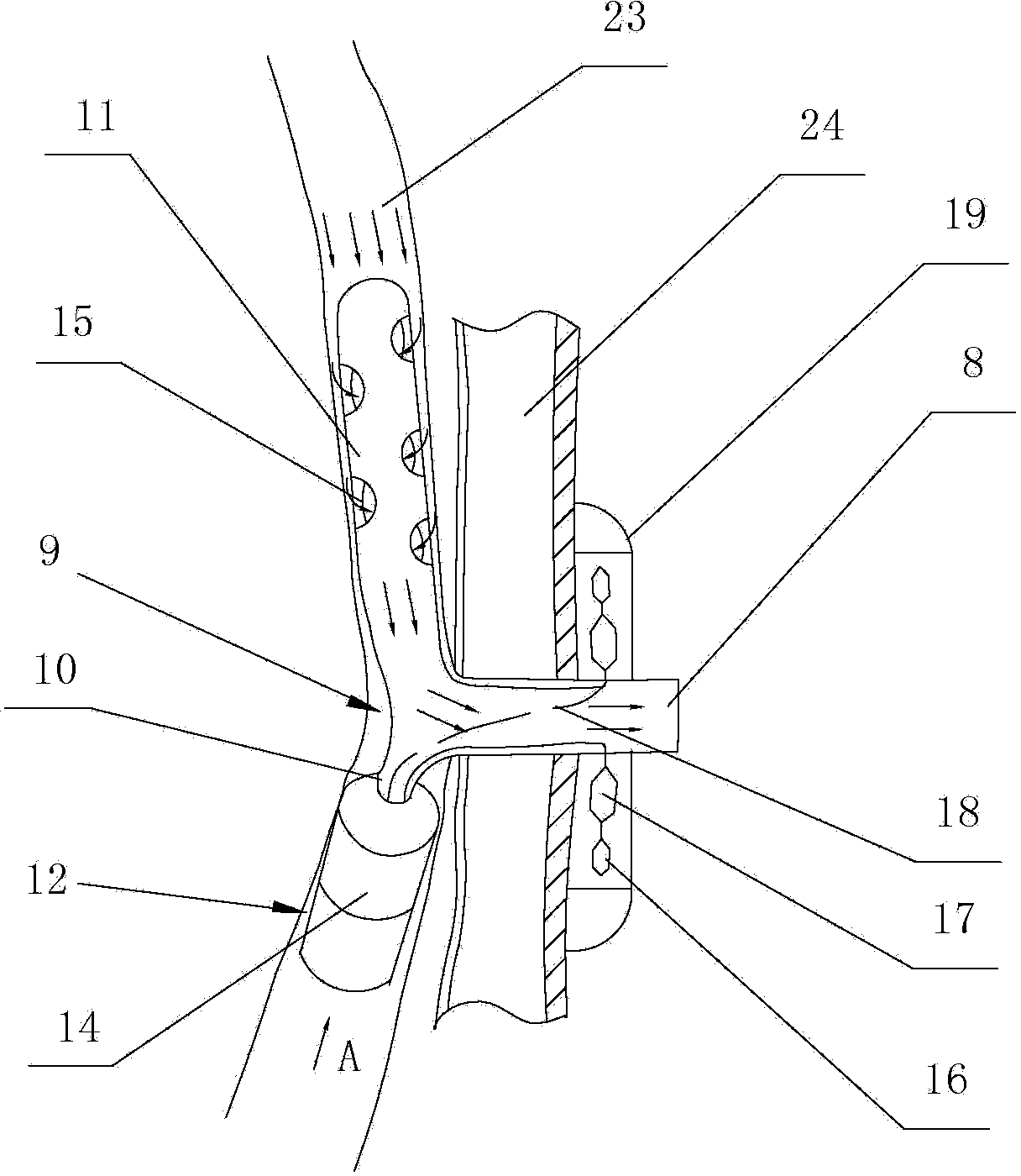 Ileum fistulization tube