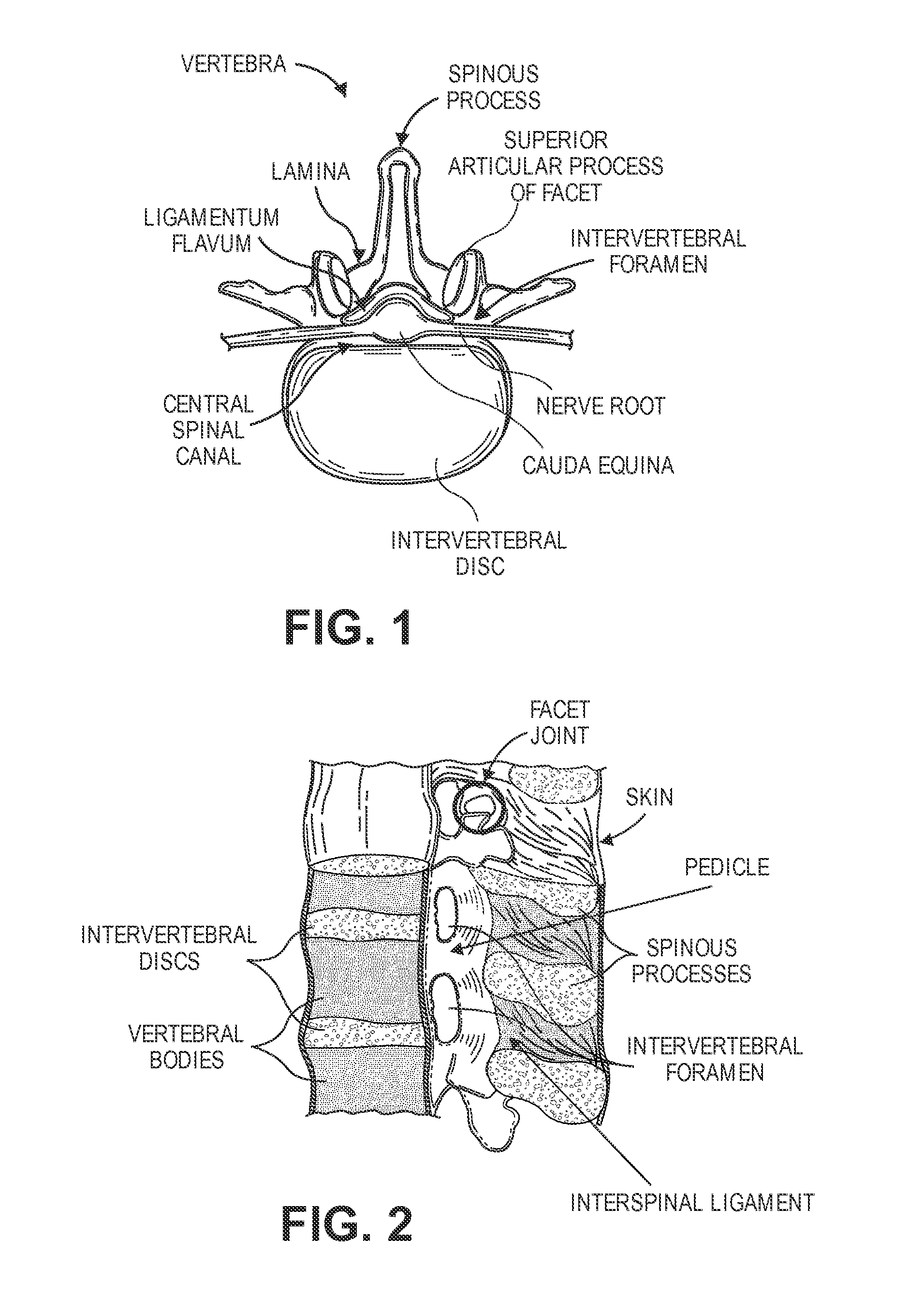 Multiple pathways for spinal nerve root decompression from a single access point