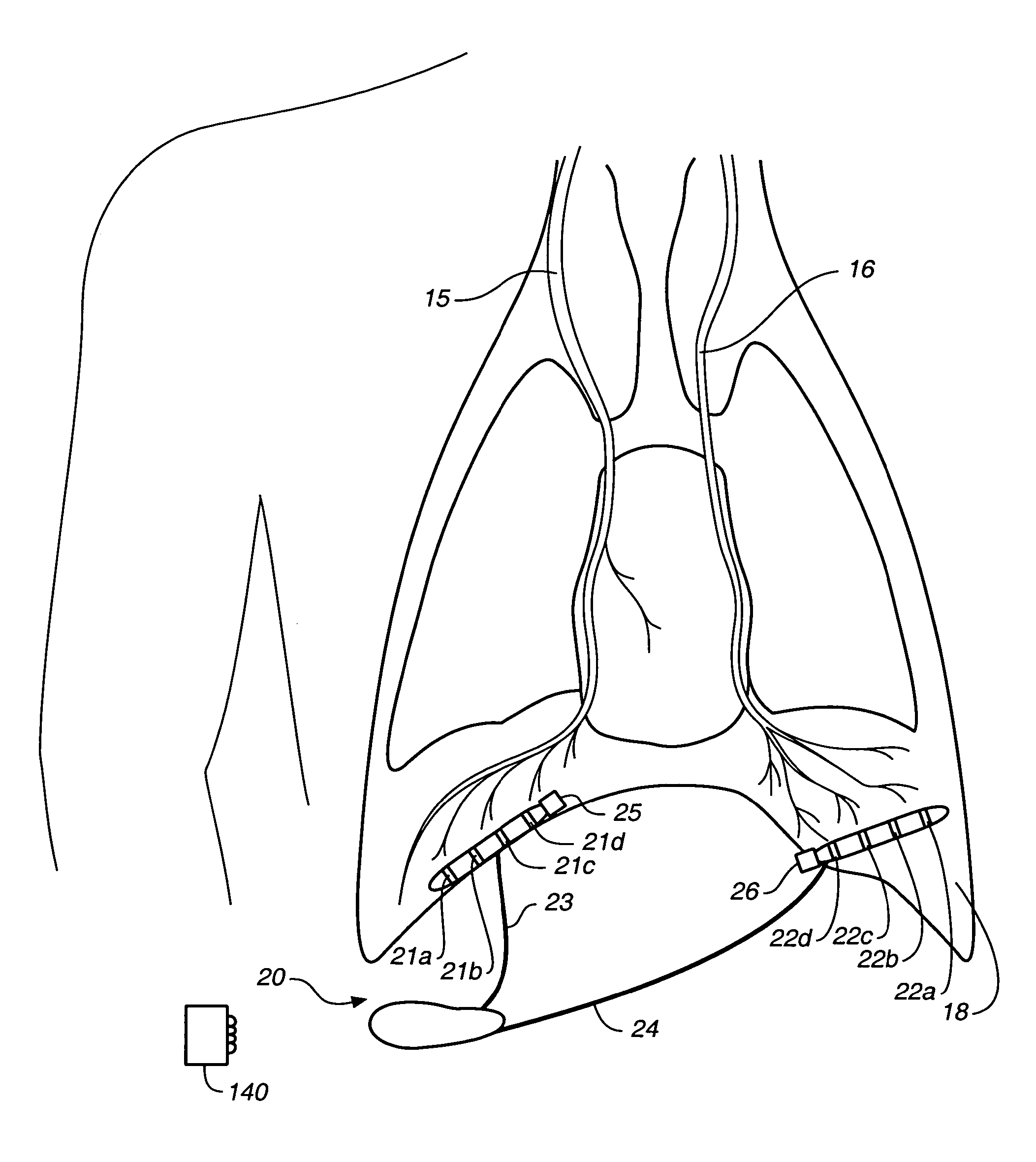 Breathing disorder detection and therapy delivery device and method