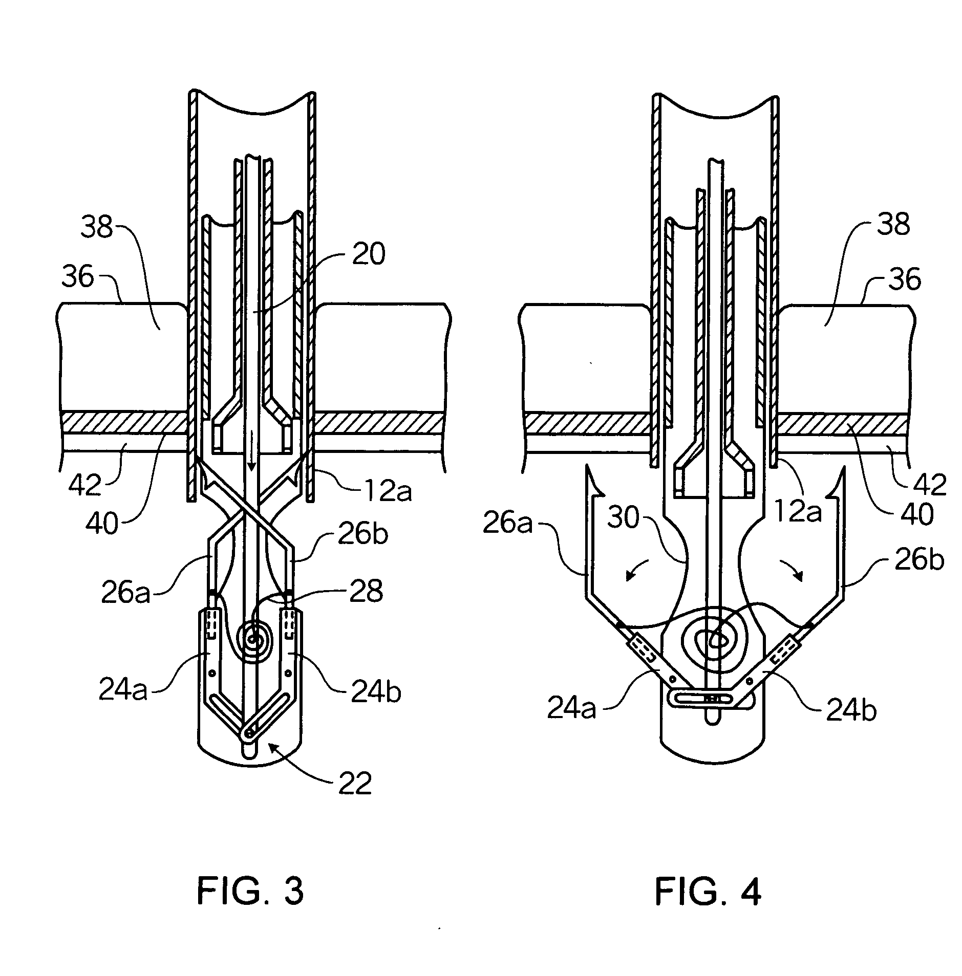 Puncture site closure device