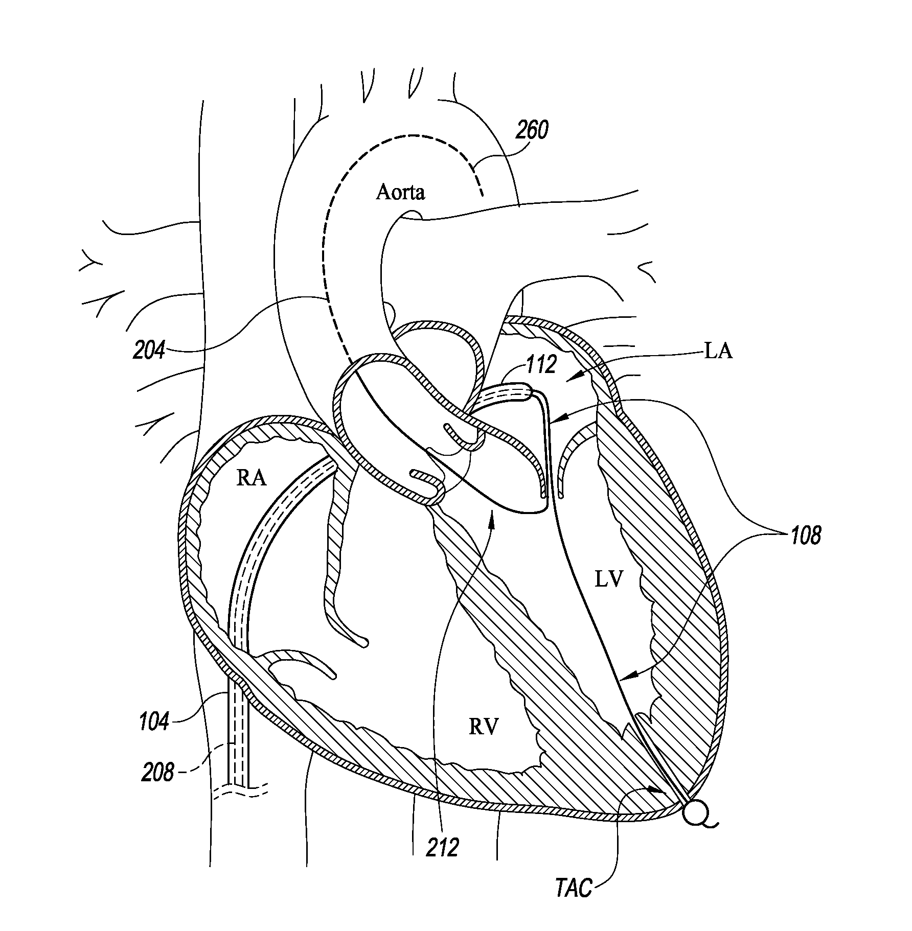 Catheter based apical approach heart prostheses delivery system