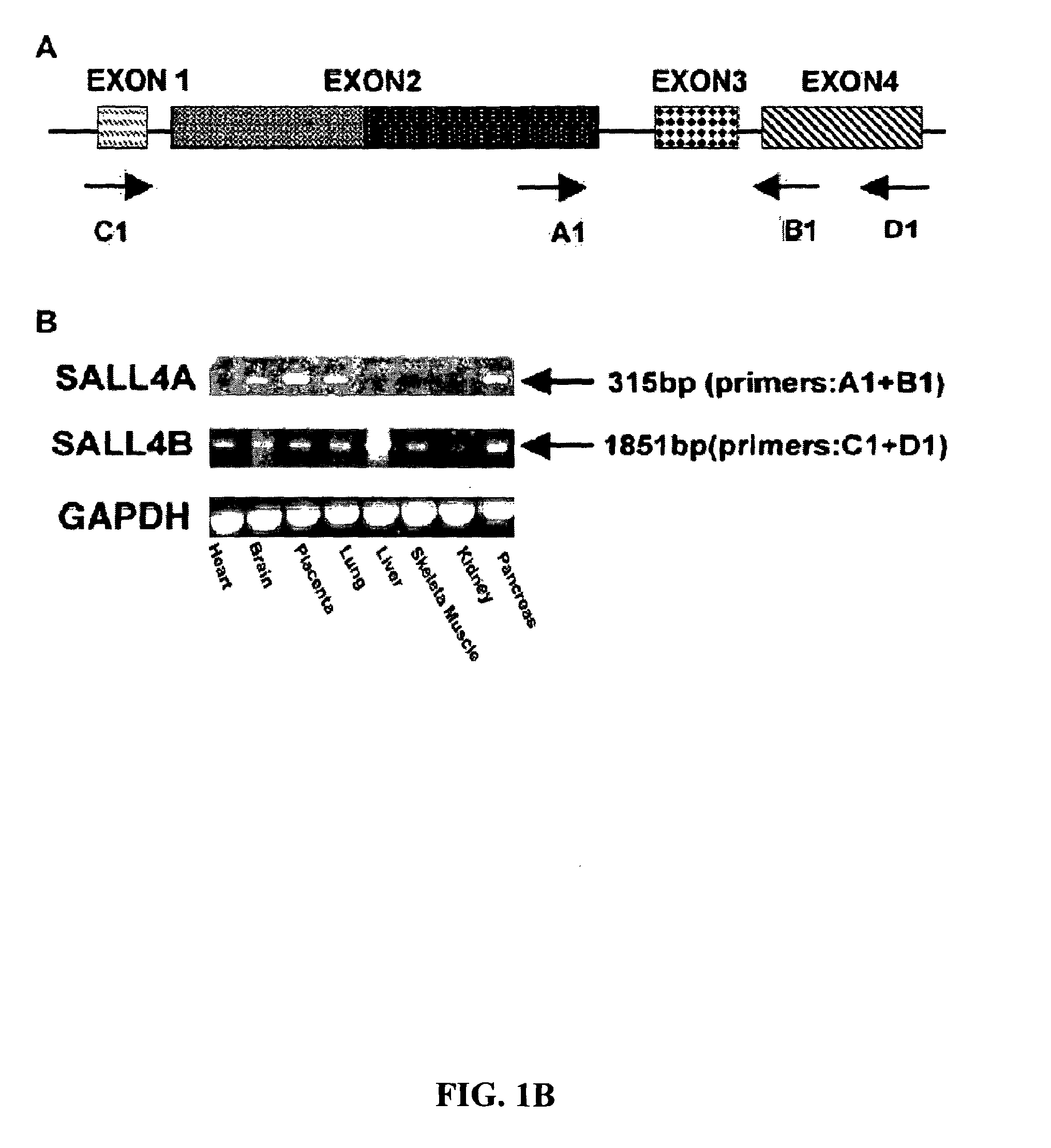 Targeting of SALL4 for the treatment and diagnosis of proliferative disorders associated with myelodysplastic syndrome (MDS)