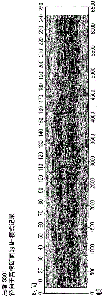 Method and system for diagnosing uterine contraction levels using image analysis