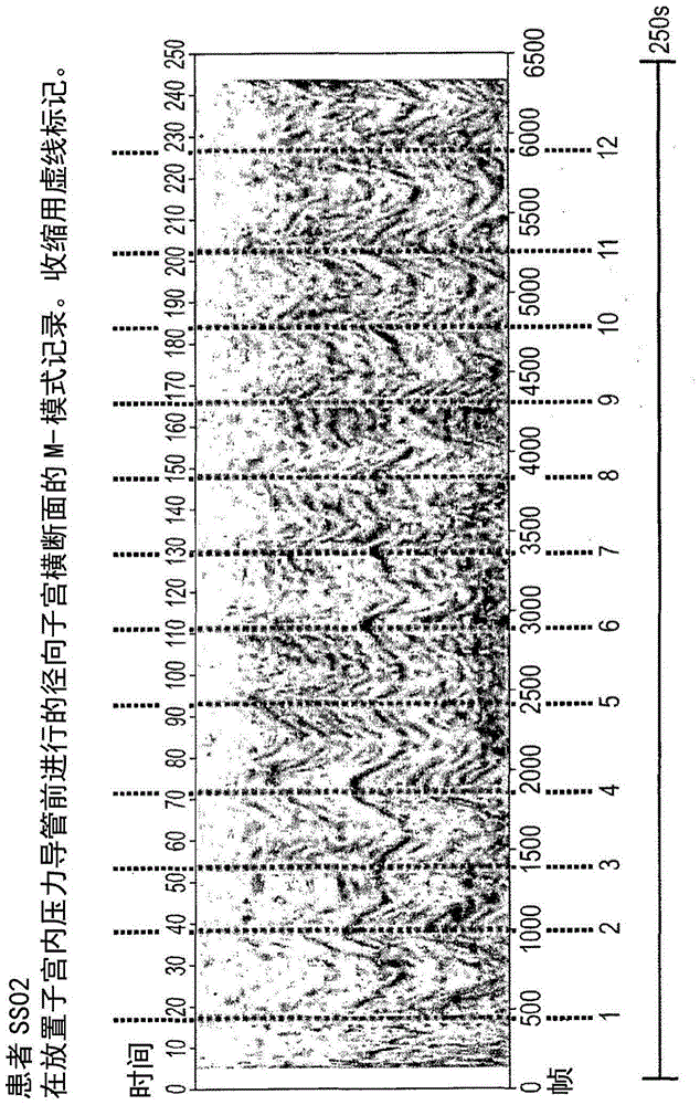 Method and system for diagnosing uterine contraction levels using image analysis