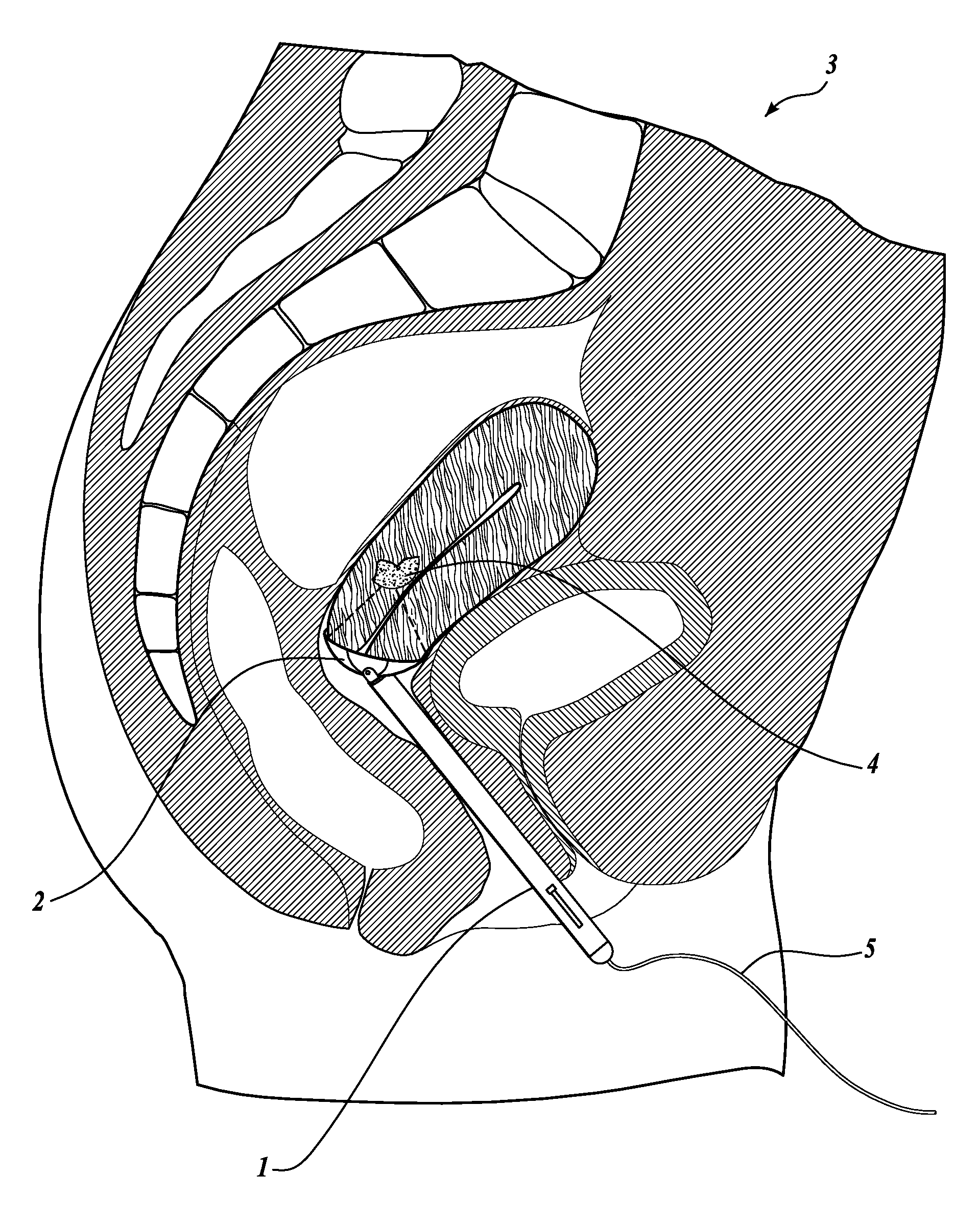 Apparatus for delivering high intensity focused ultrasound energy to a treatment site internal to a patient's body