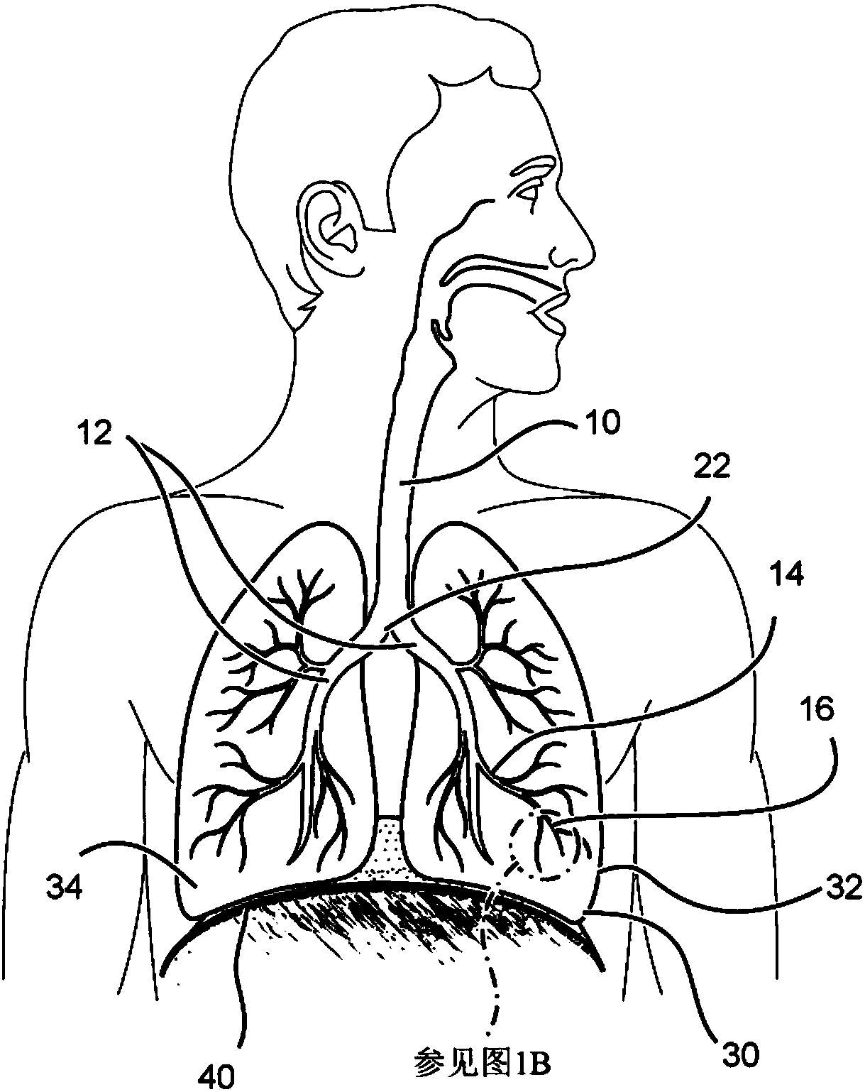 Methods and devices for the treatment of pulmonary disorders