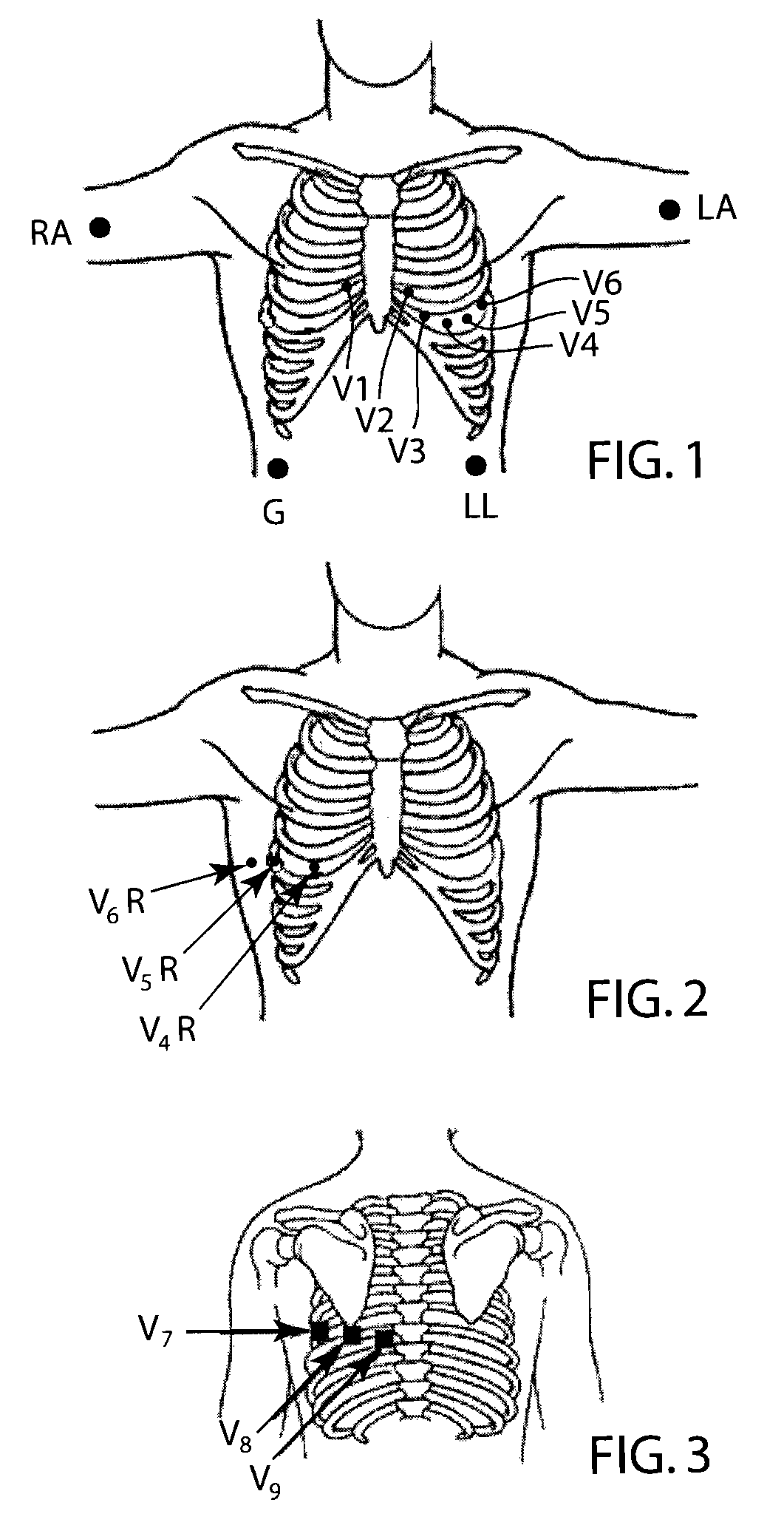 Method and apparatus with reduced electrode system specific ECG interpretation