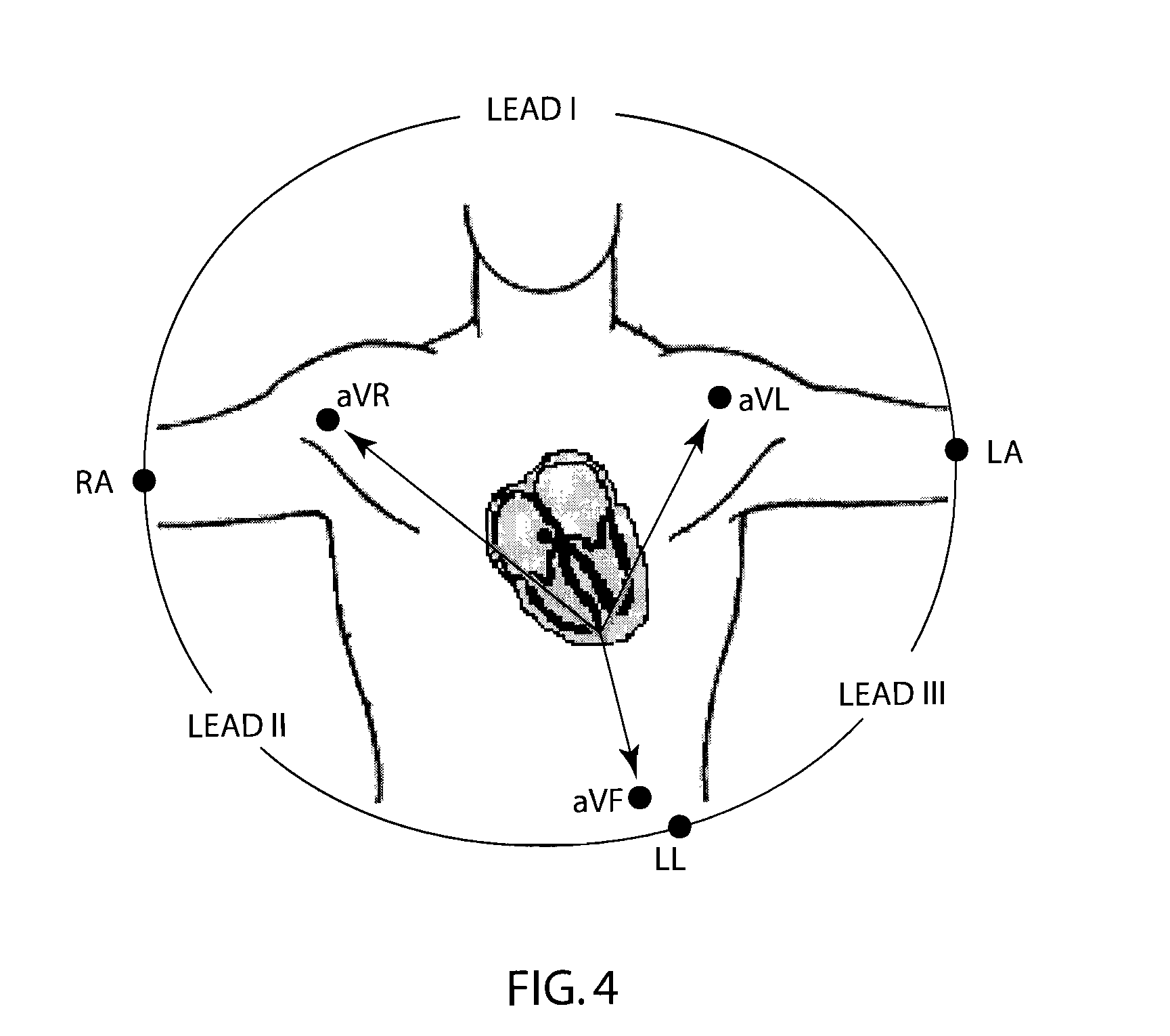 Method and apparatus with reduced electrode system specific ECG interpretation