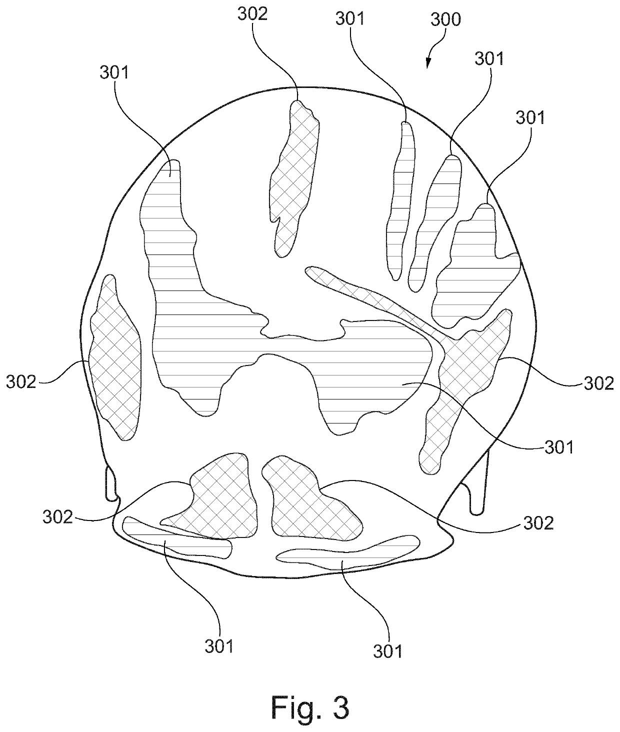 Automated pre-operative assessment of implant placement in human bone